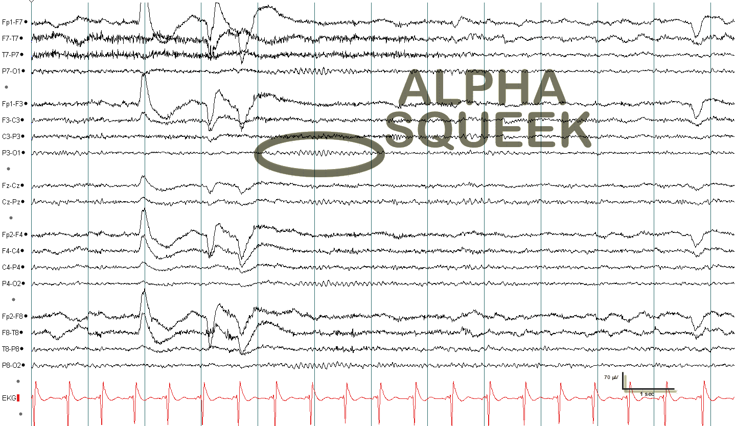 Alpha squeak EEG example 3 with annotation