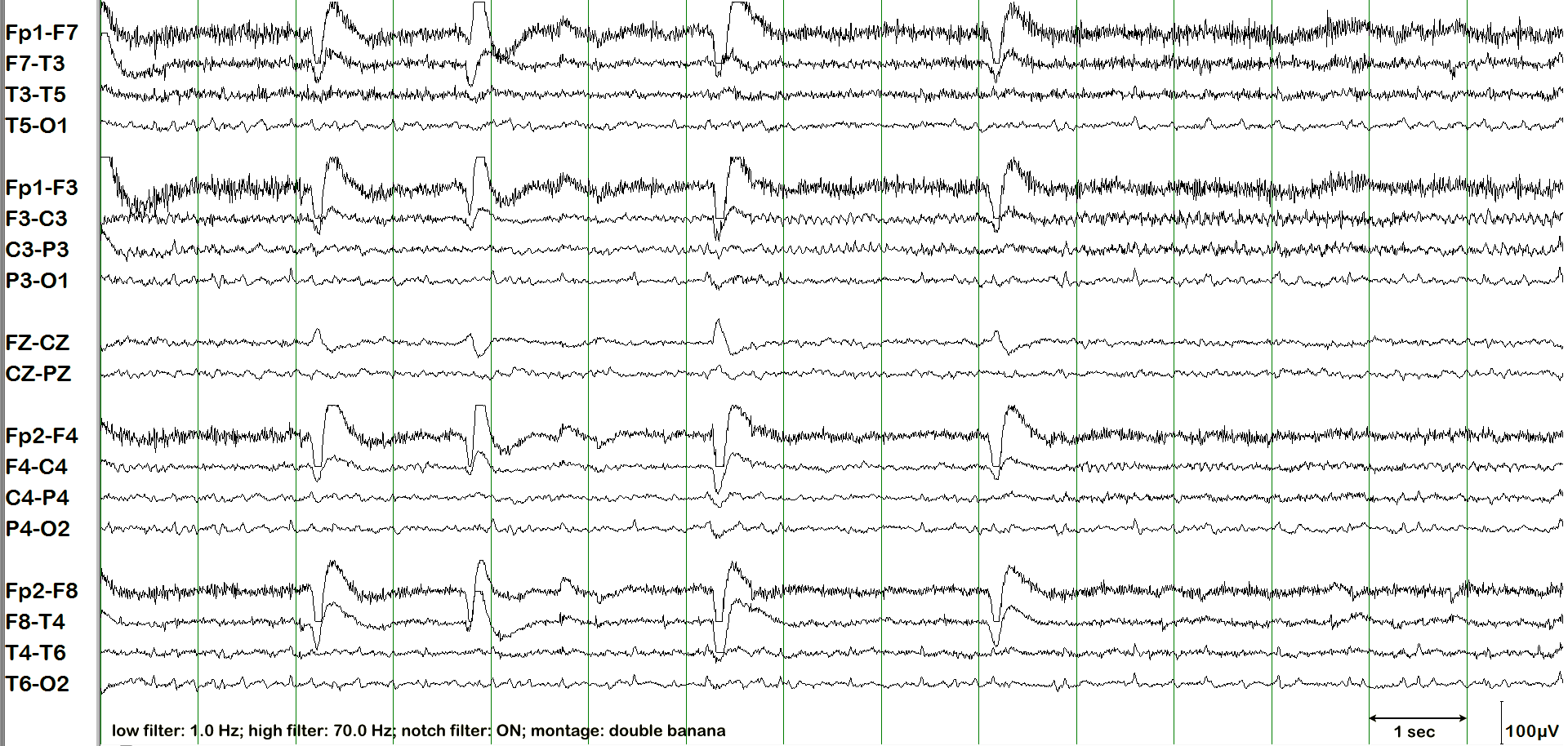 Mu rhythm EEG example 1 without annotation