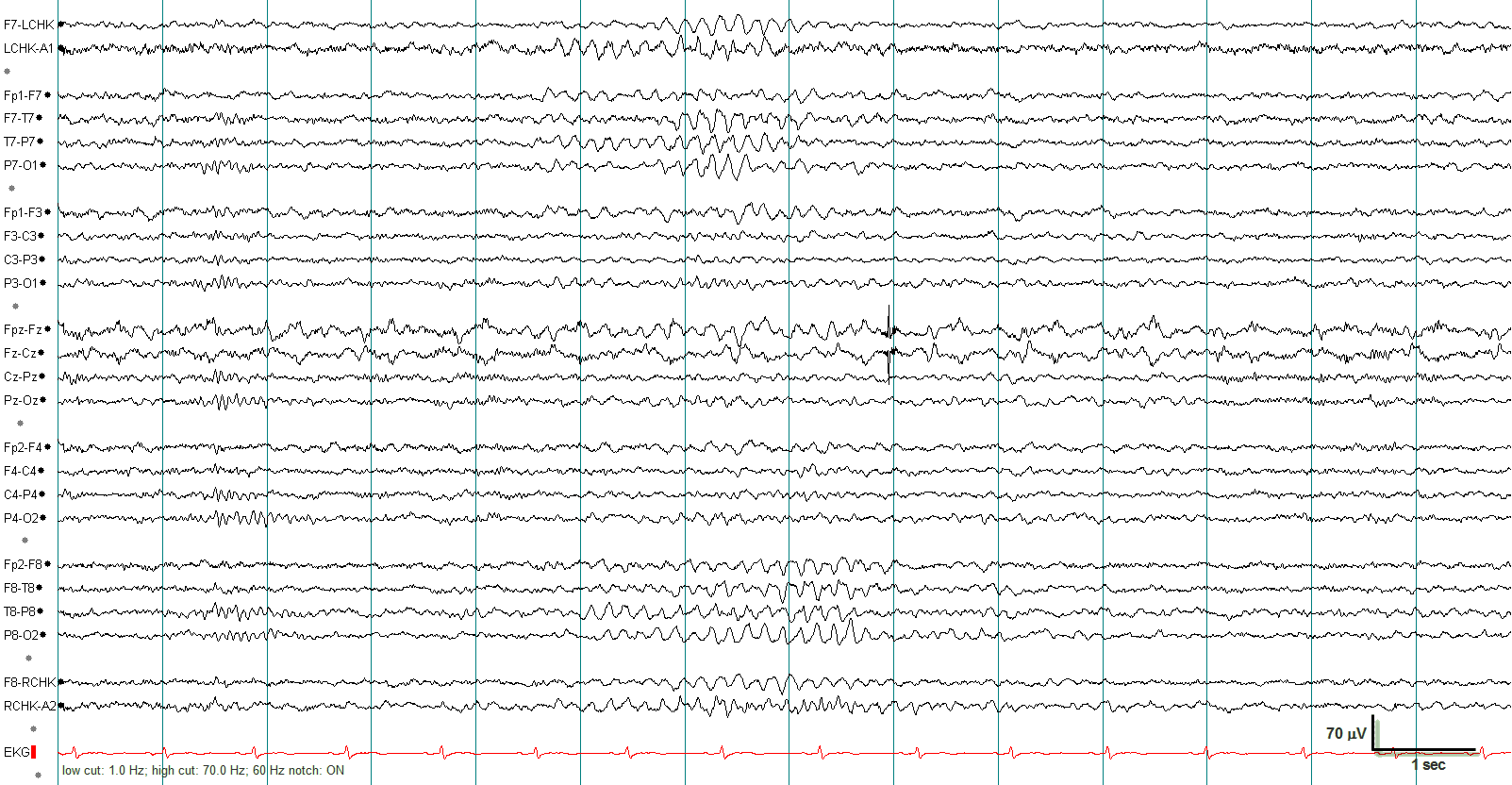 RMTD EEG example