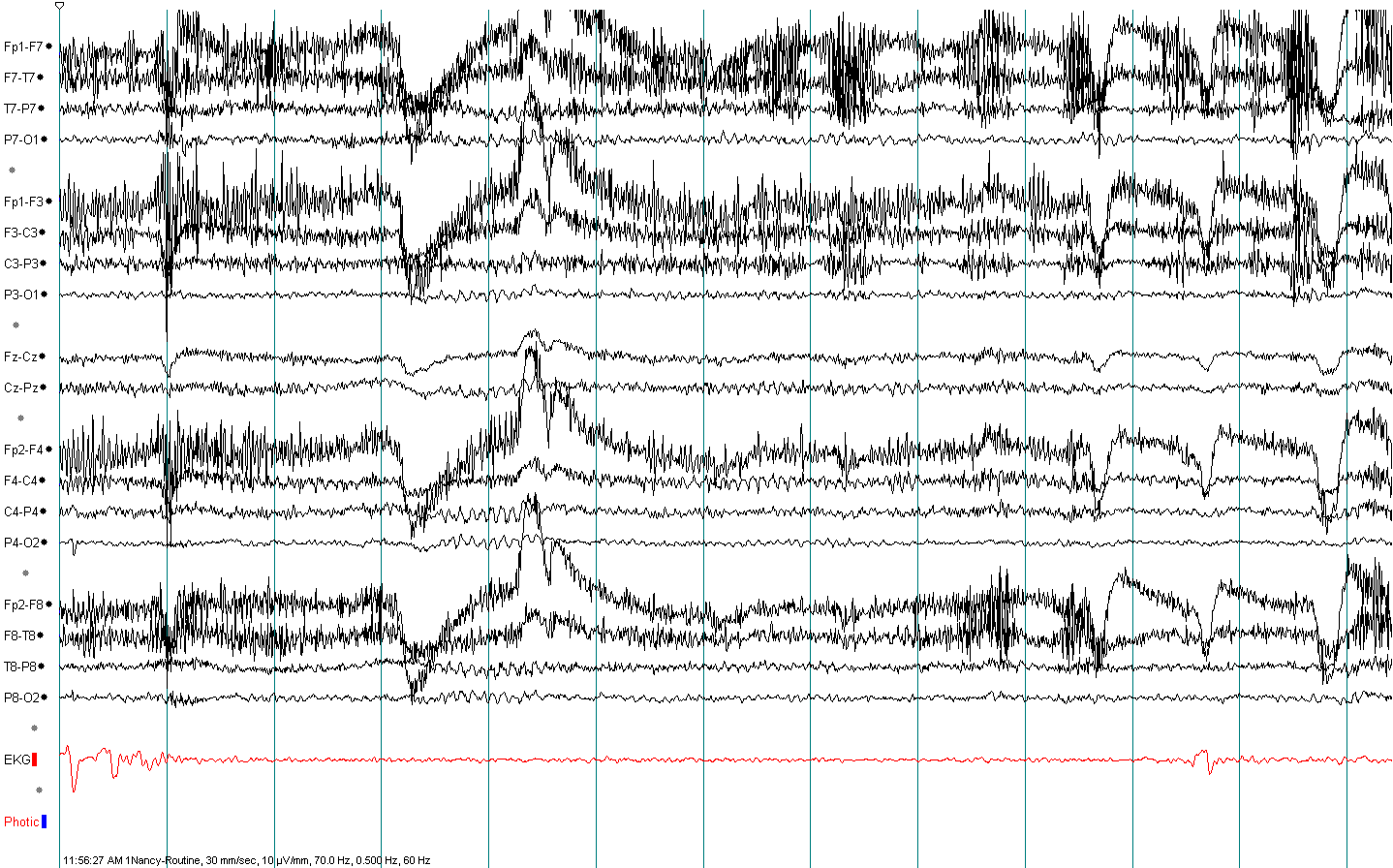 Mu rhythm EEG example 2 without annotation