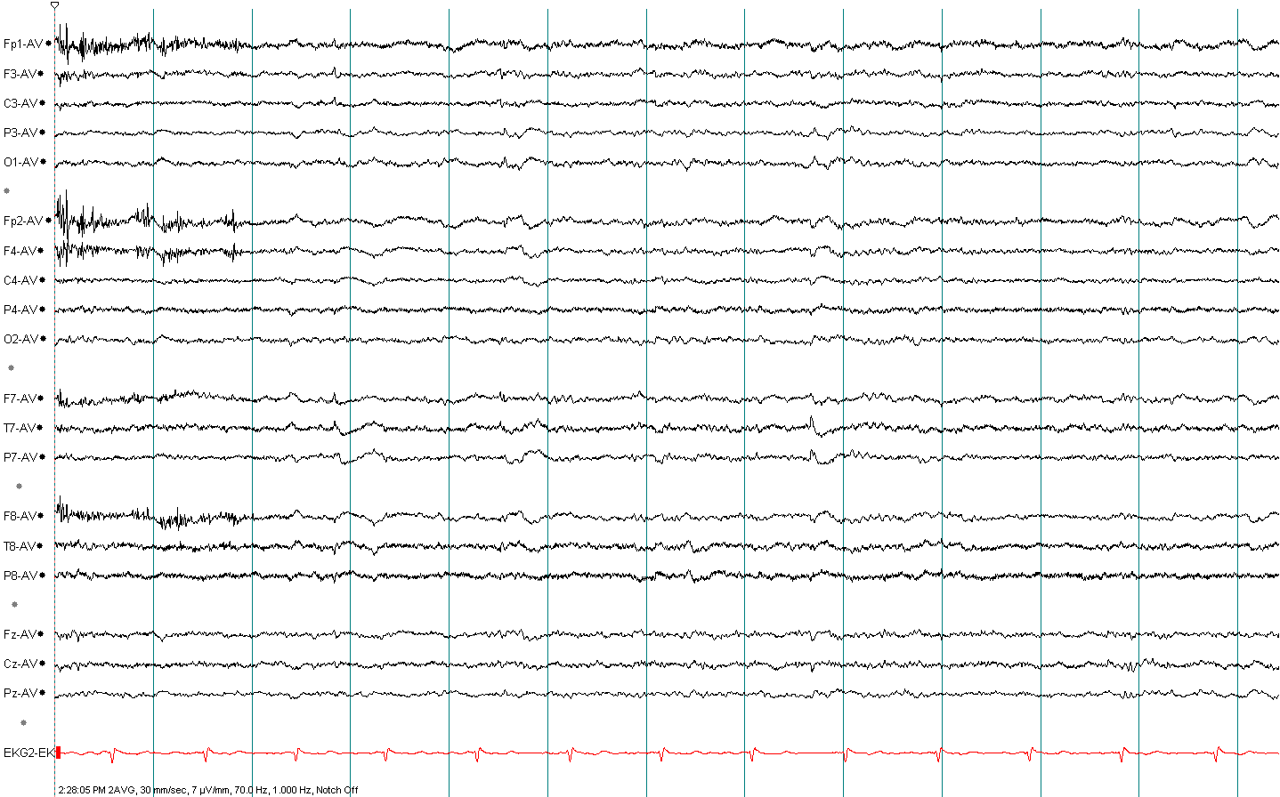 Small sharp spikes BETS EEG example