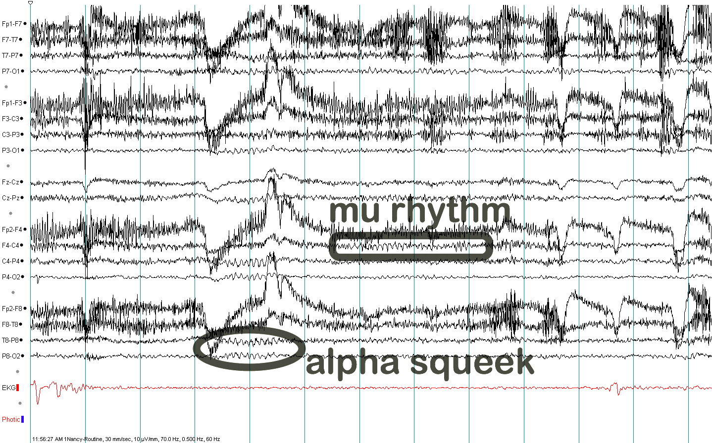 Mu rhythm EEG example 2 with annotation