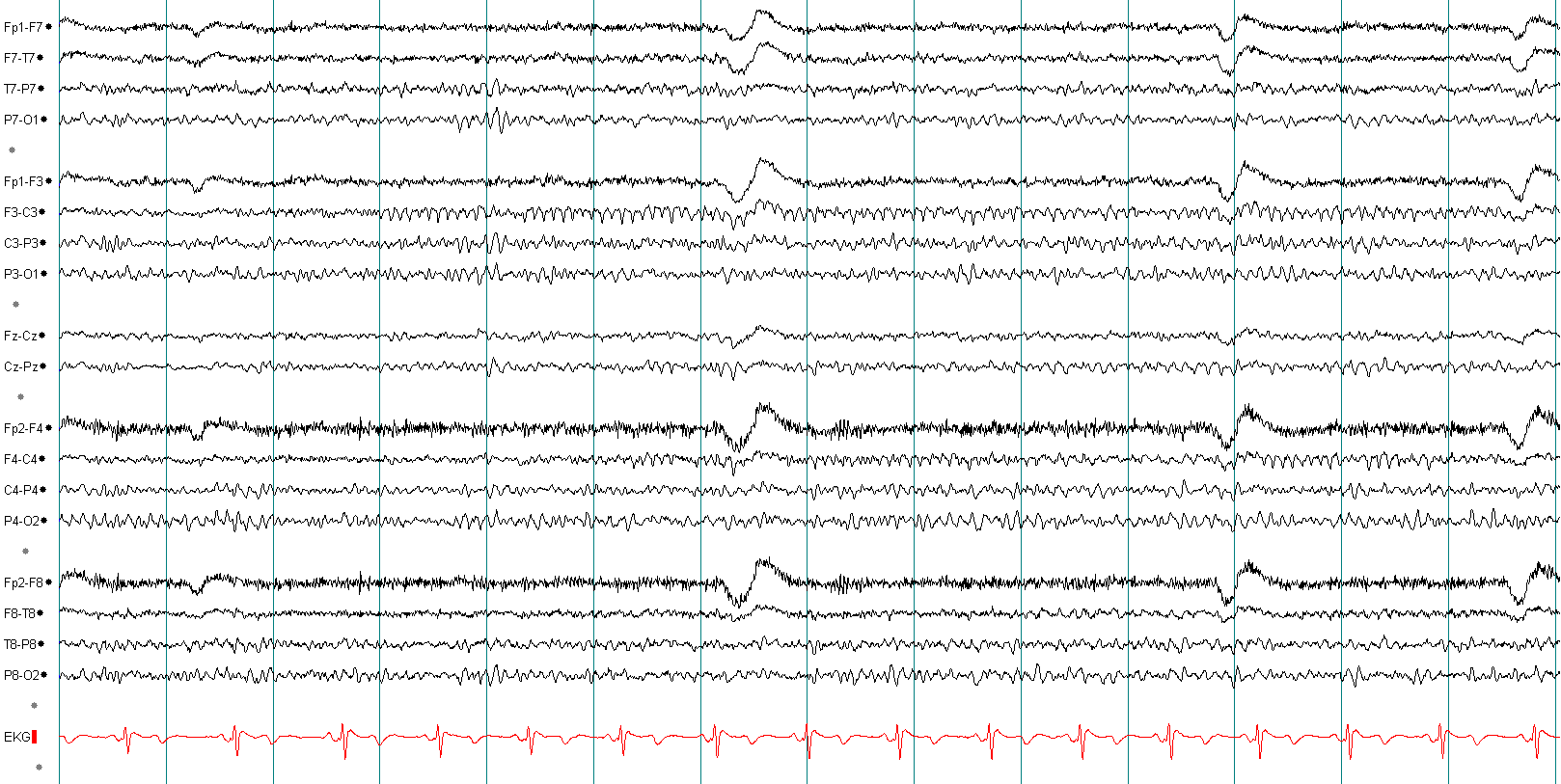 Mu rhythm EEG example 3 without annotation