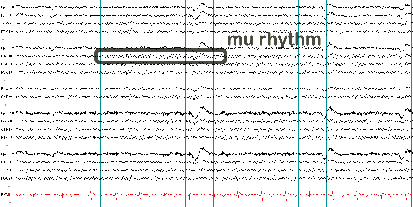 Mu rhythm EEG example 3 with annotation