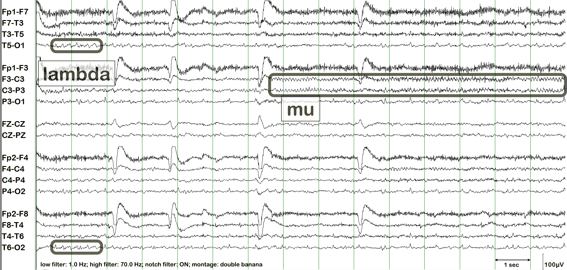 Lambda waves EEG example 1 with annotation