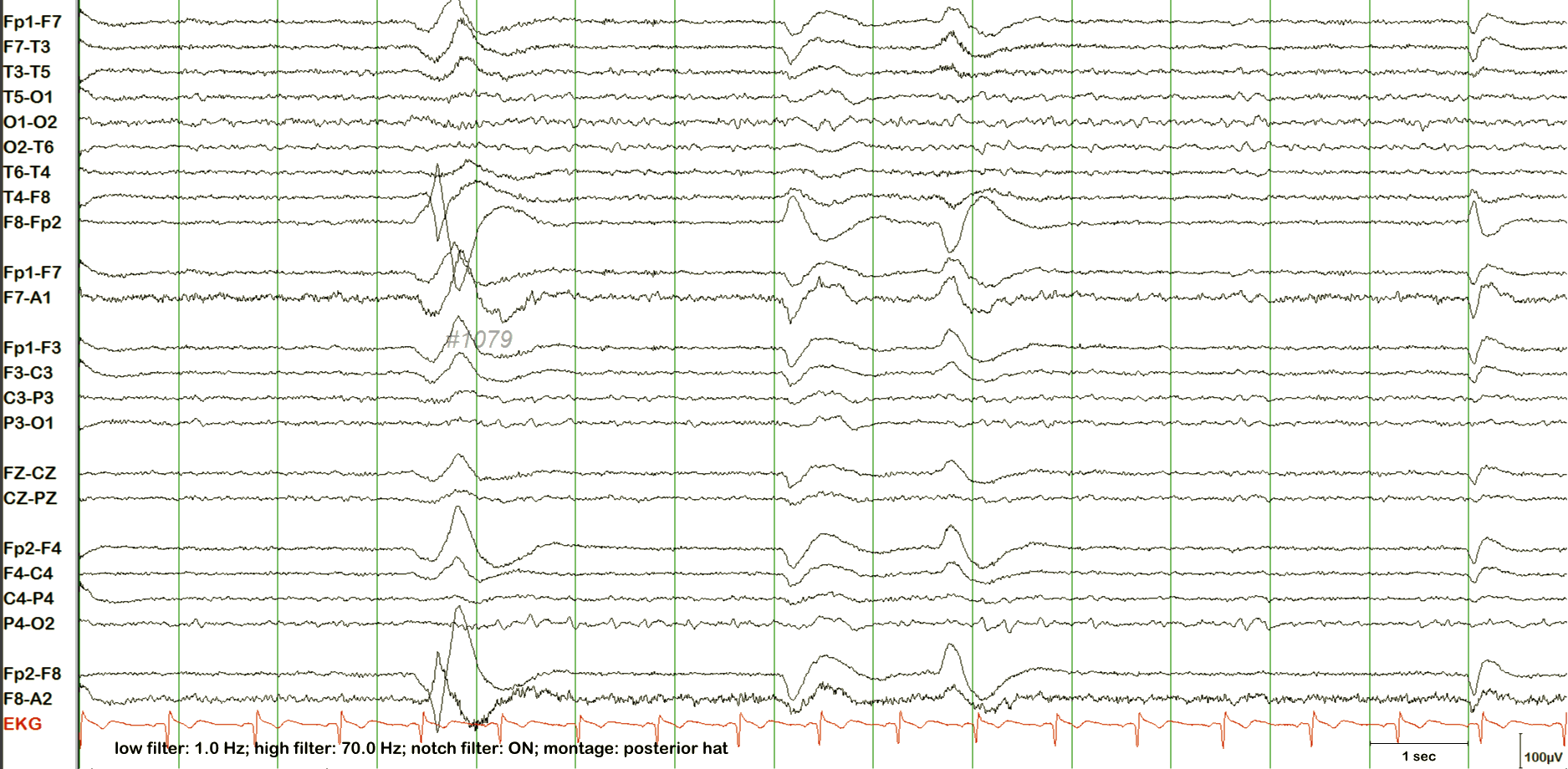 Lambda waves EEG example 2 without annotation