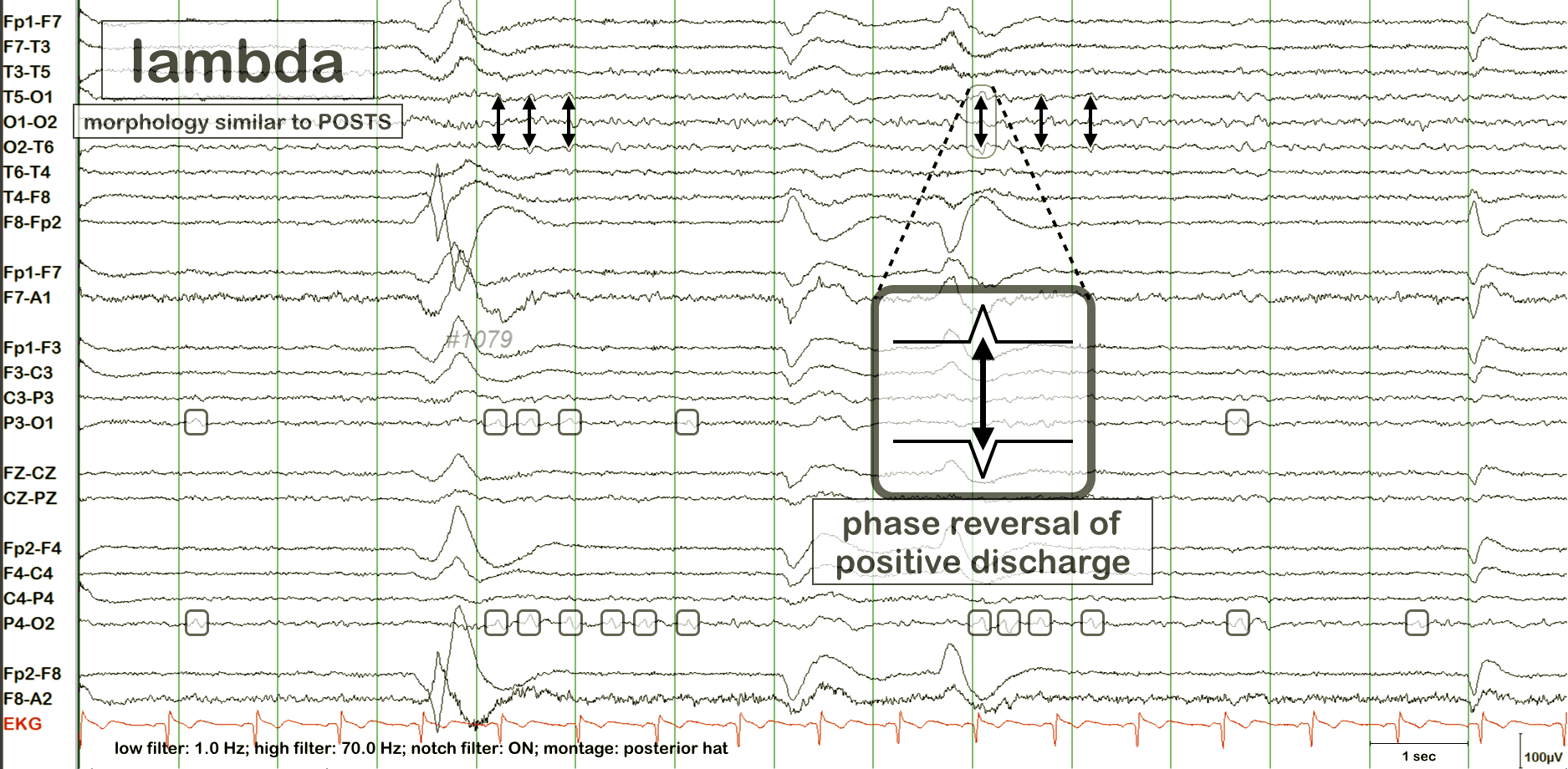 Lambda waves EEG example 2 with annotation
