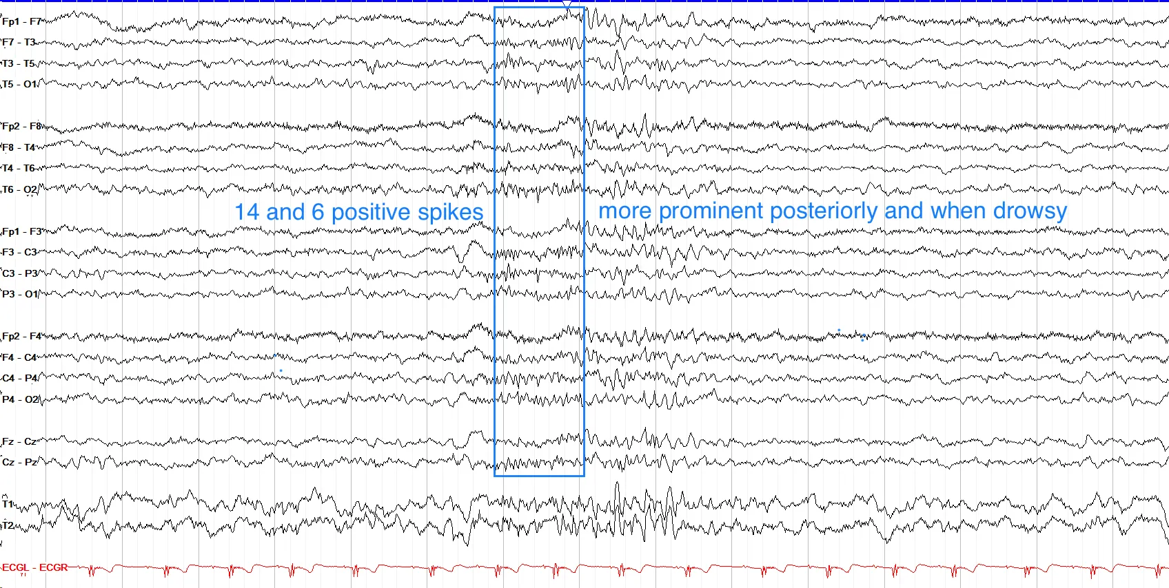 14 and 6 Hz positive bursts EEG example