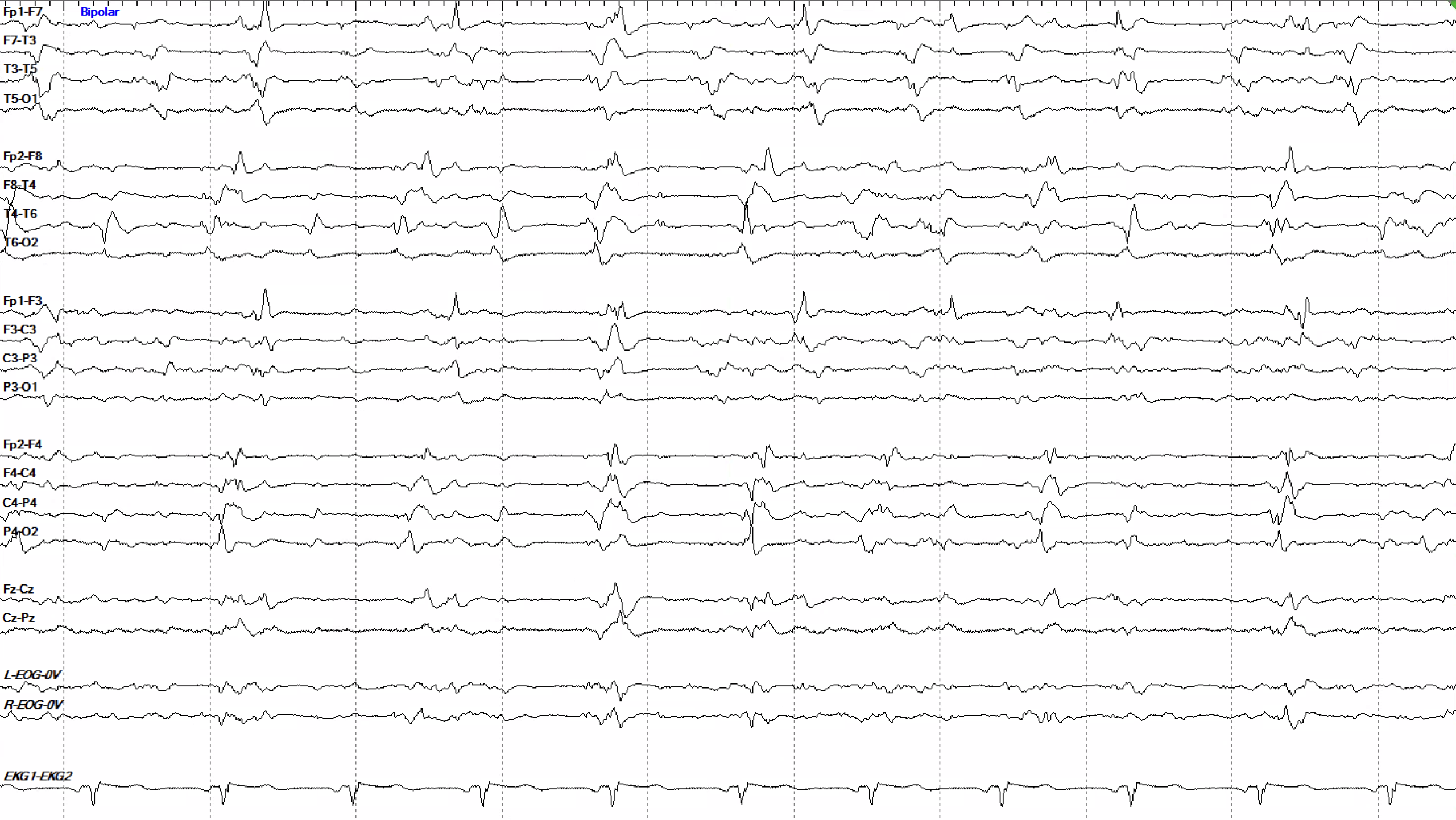 Asynchronous GPDs versus BiPDs EEG OFF