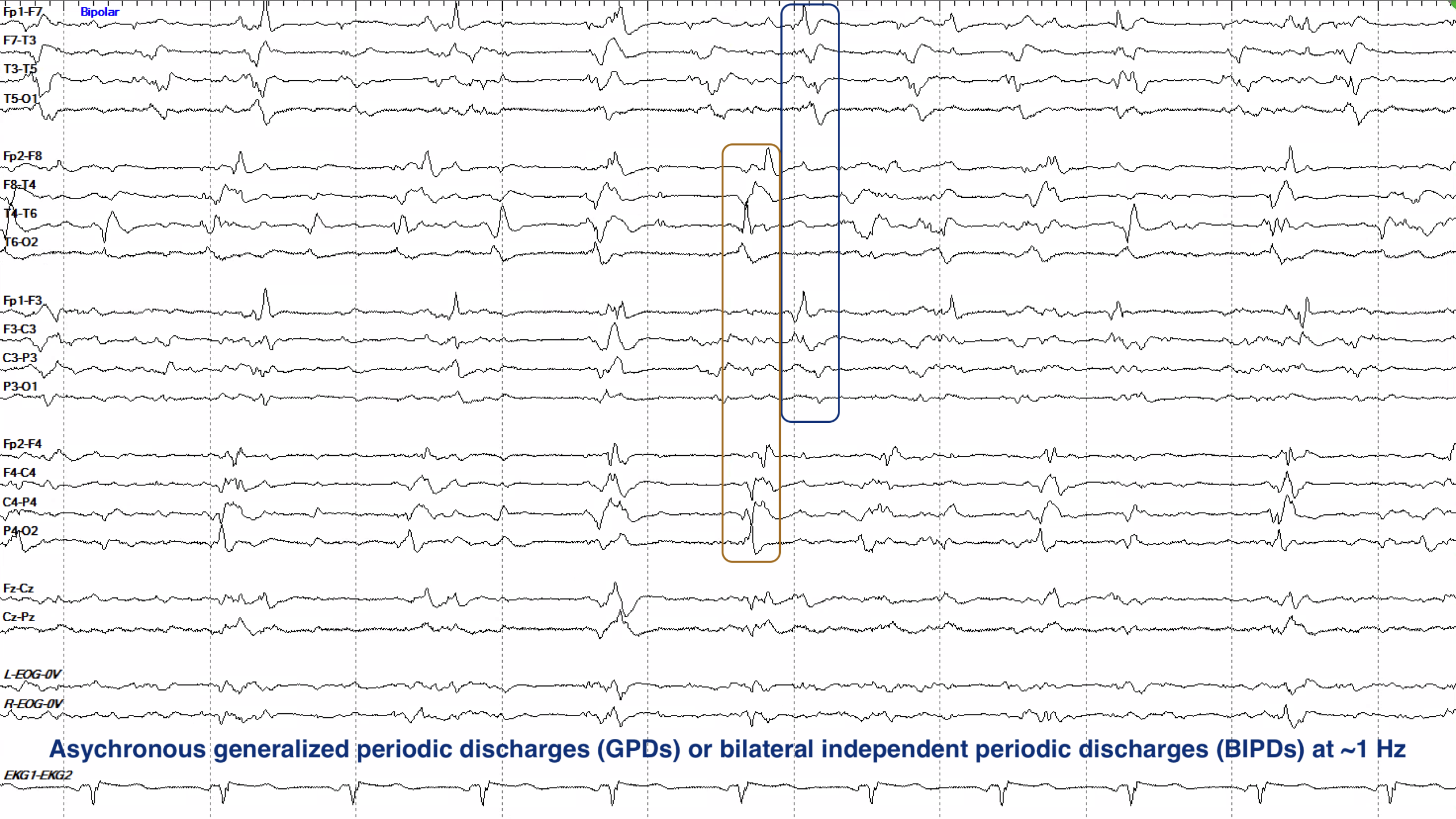 Asynchronous GPDs versus BiPDs EEG ON