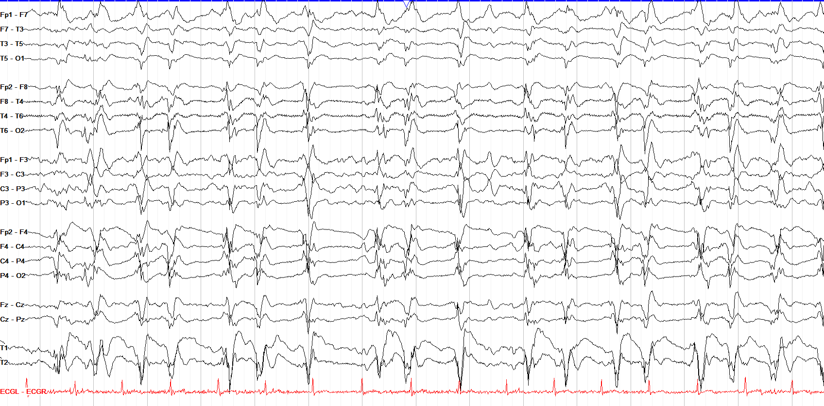 GPDs plus F EEG OFF