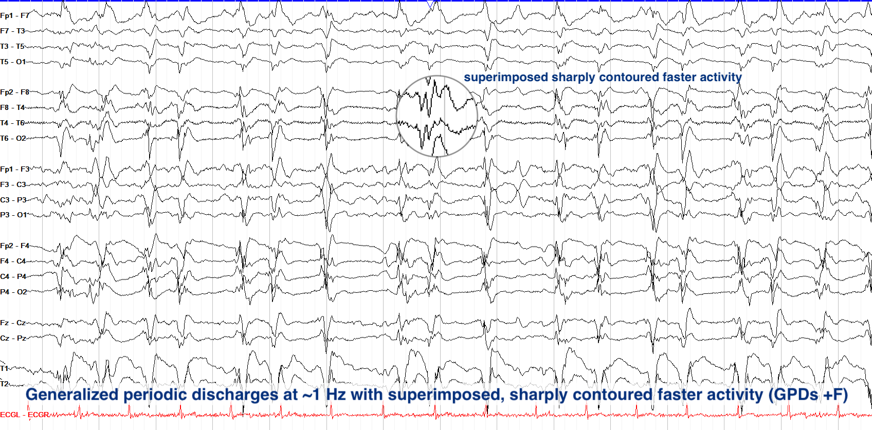 GPDs plus F EEG ON