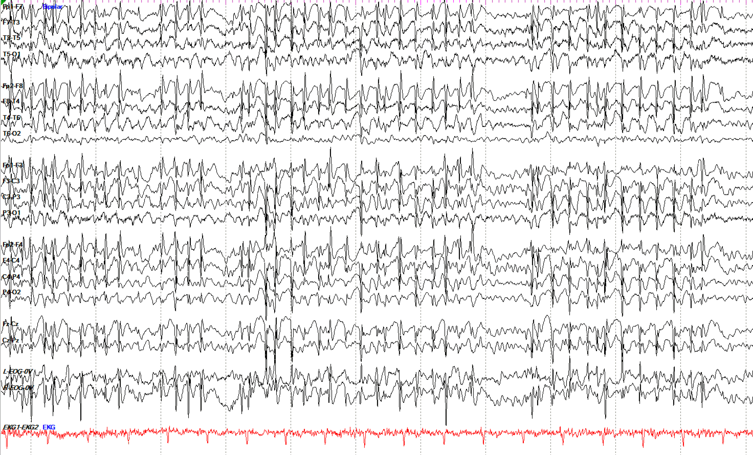 Generalized Periodic Discharges EEG OFF