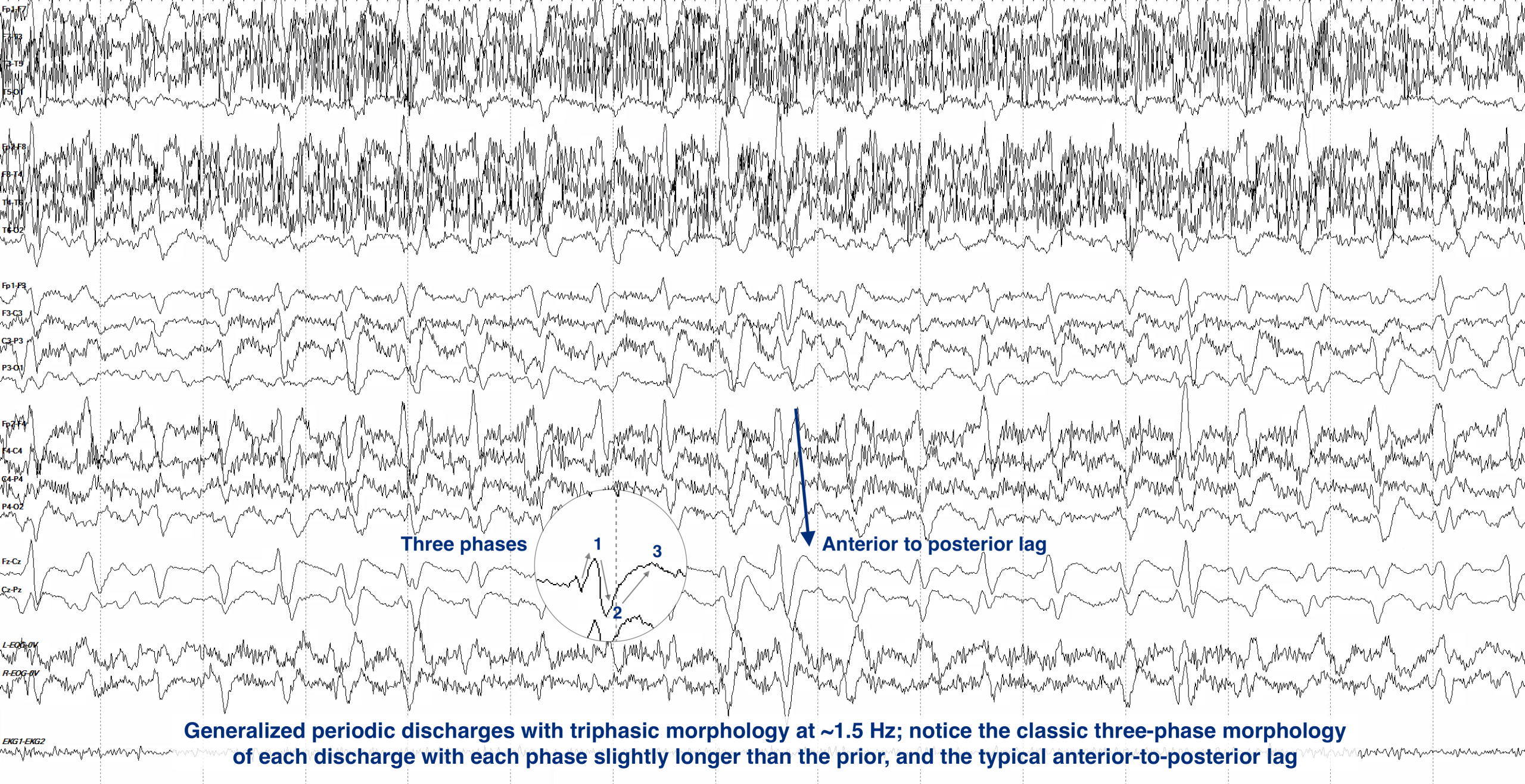 Generalized Periodic Discharges EEG ON