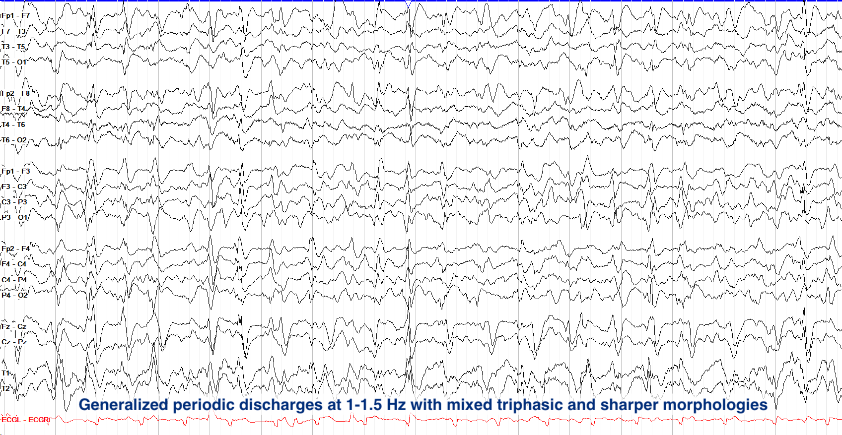 GPDs with mixed morphologies comparison EEG trace