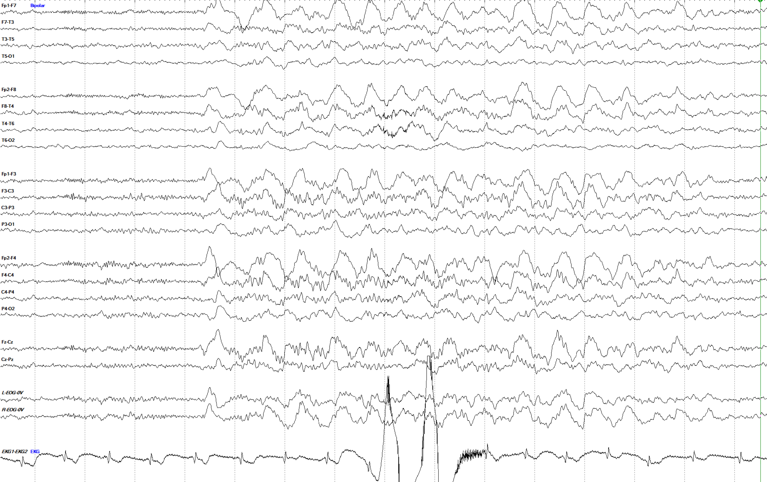 GRDA example 2 EEG OFF