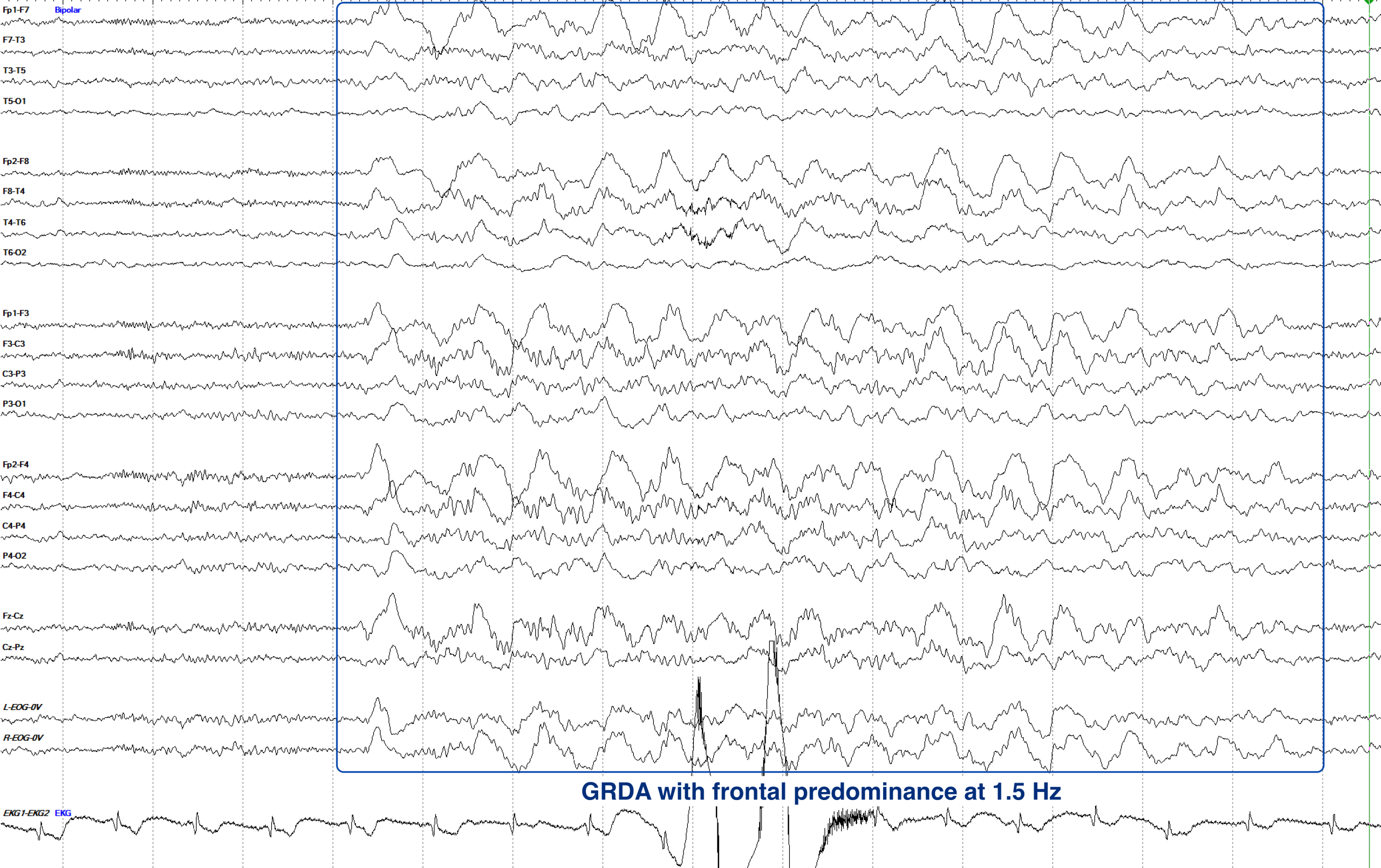 GRDA example 2 EEG ON