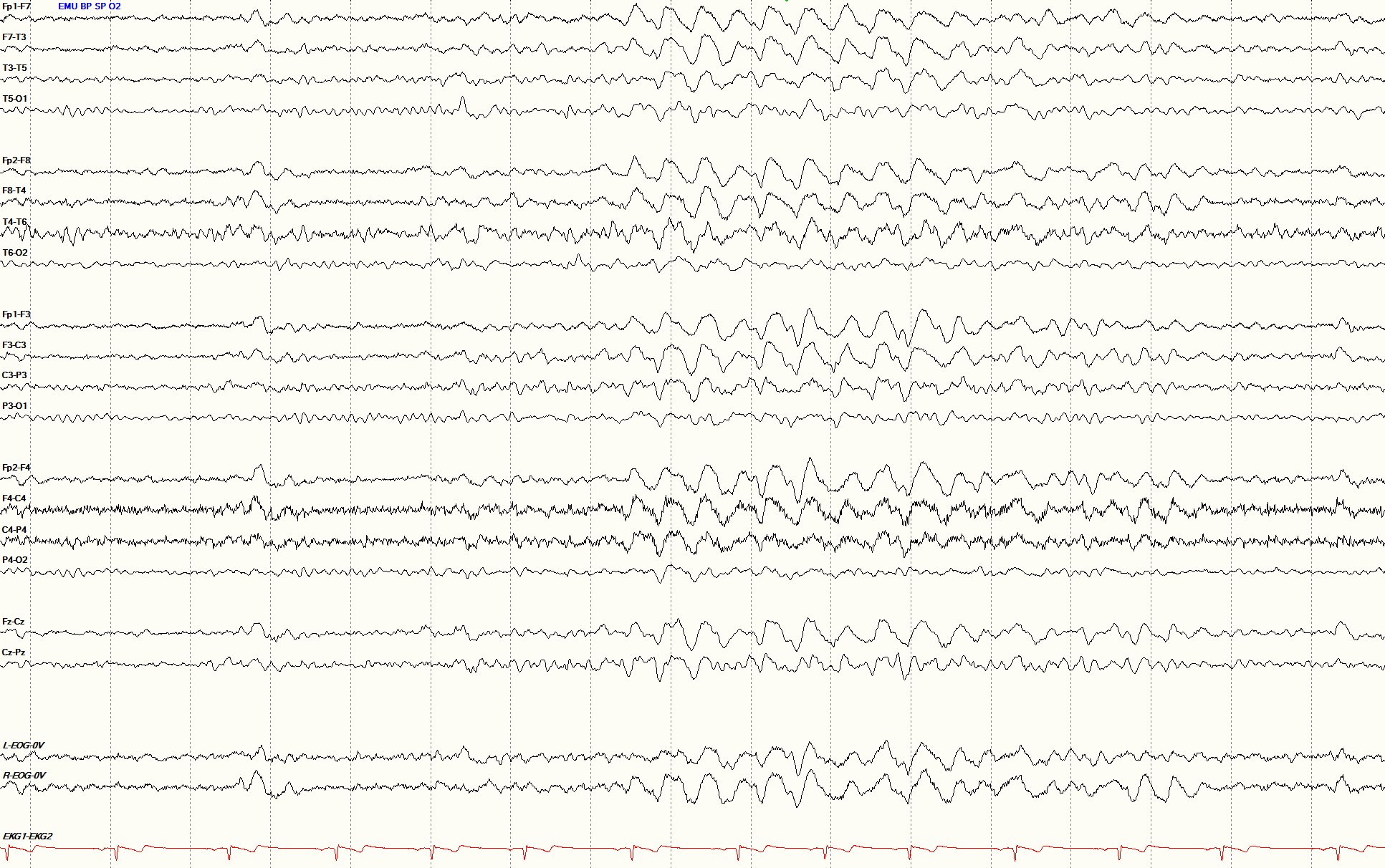 GRDA plus S EEG OFF