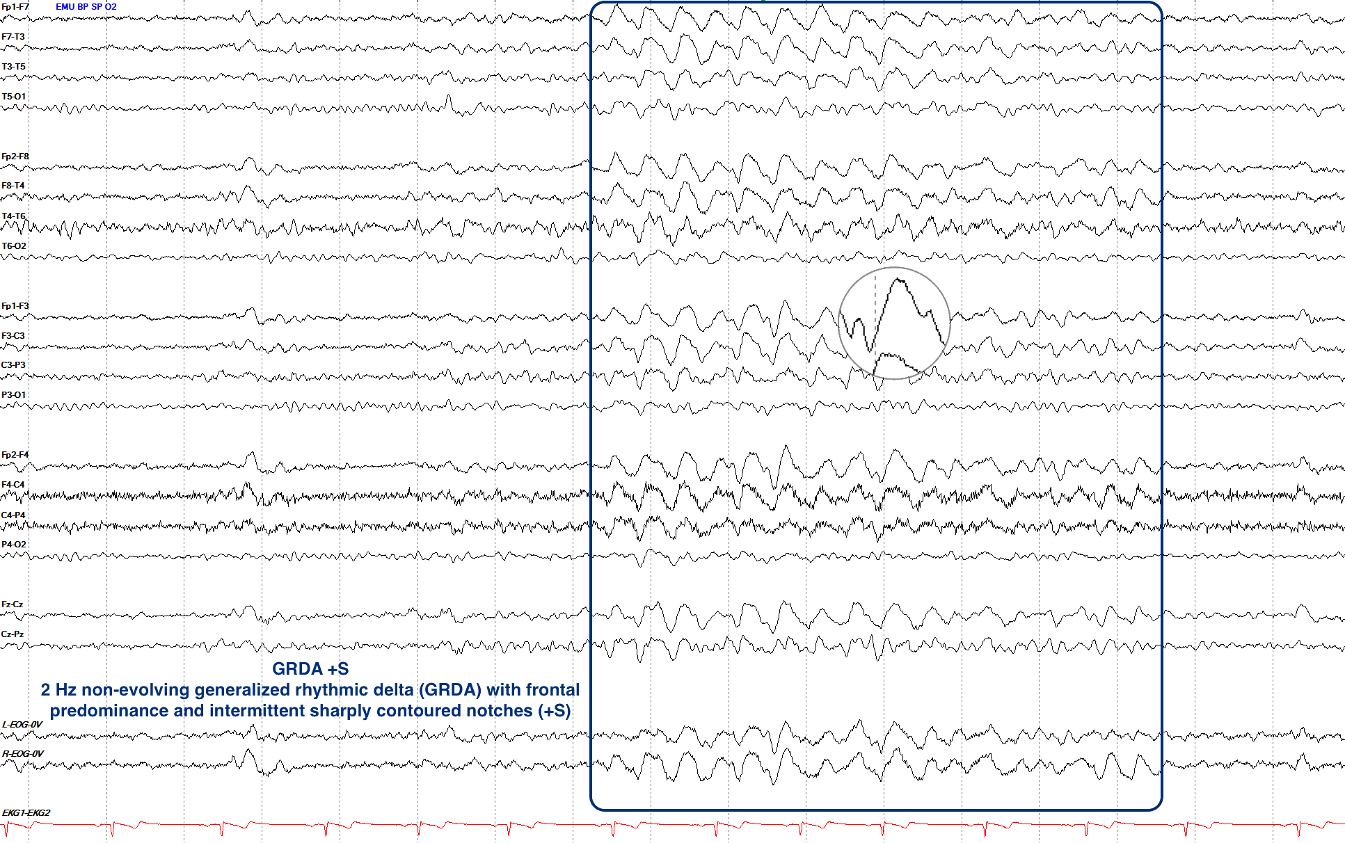 GRDA plus S EEG ON