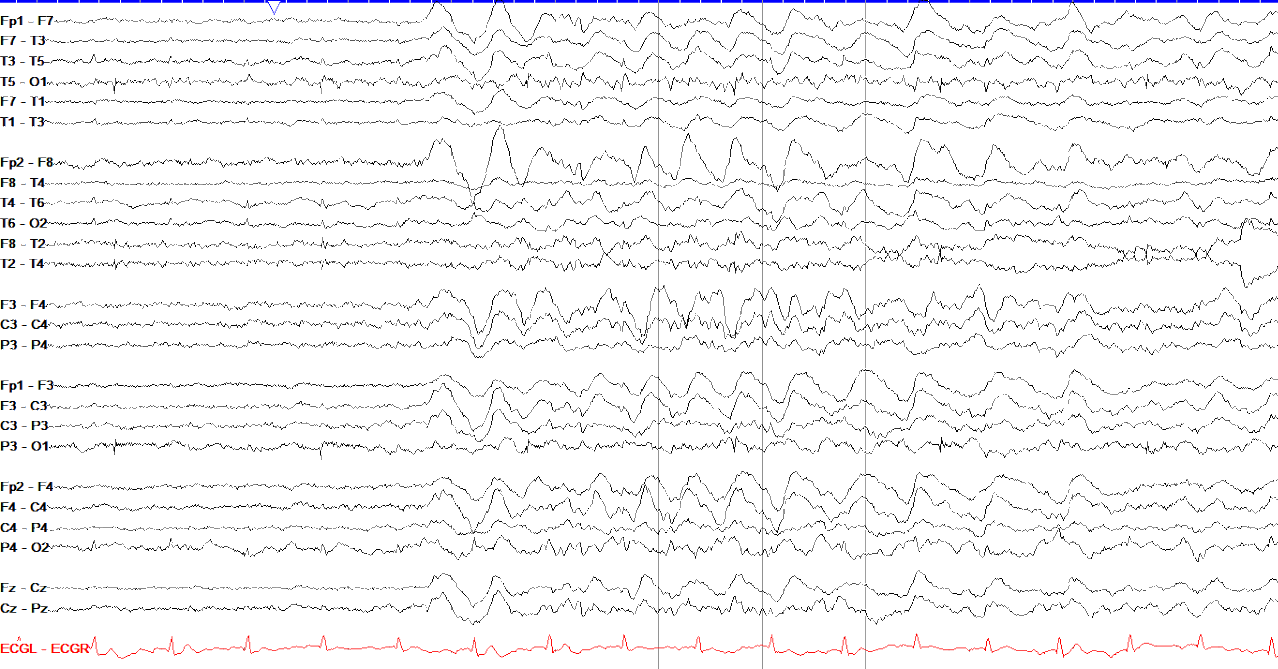 GRDA EEG OFF