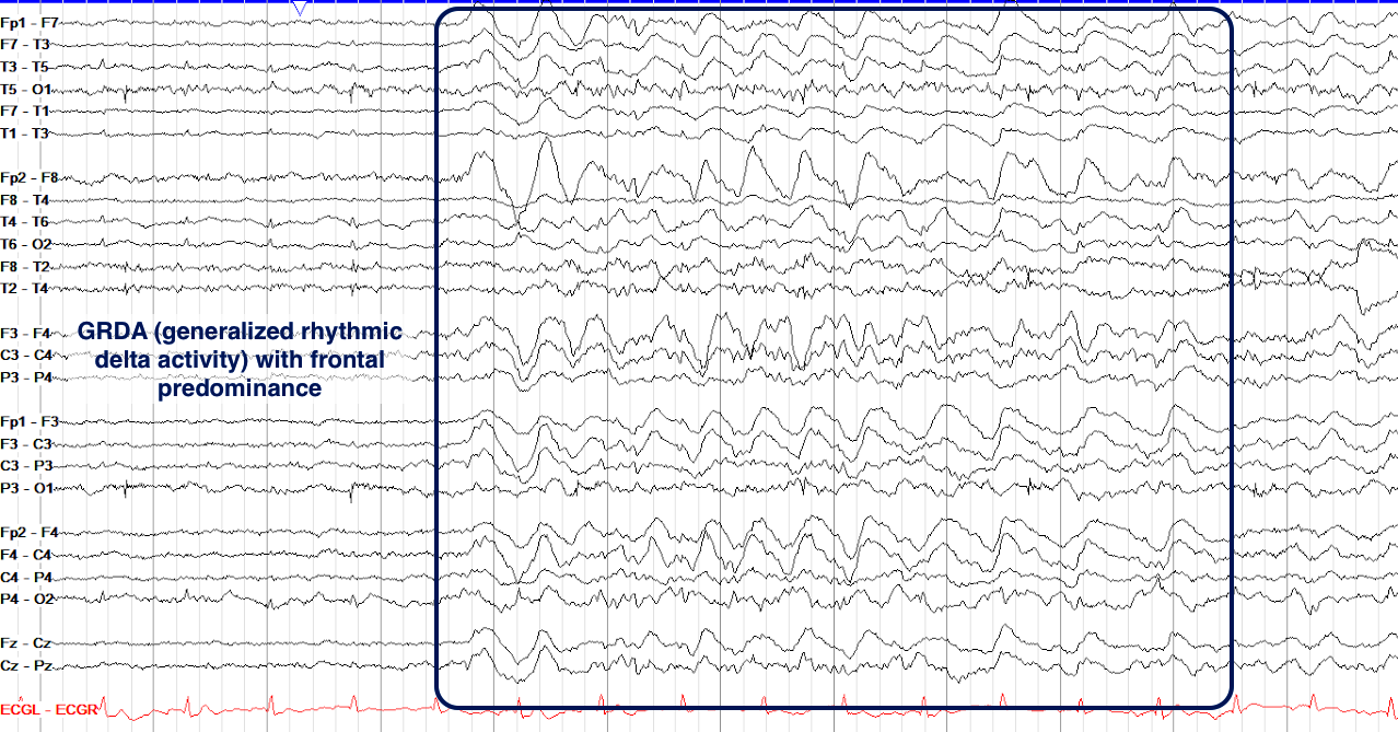 GRDA EEG ON