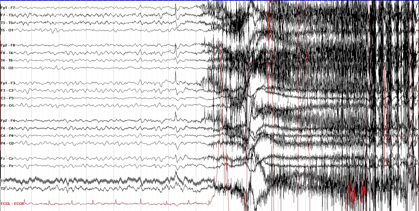 Generalized seizure EEG OFF