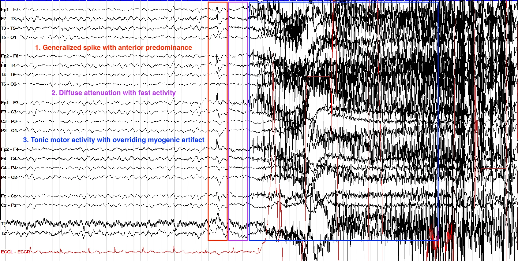 Generalized seizure EEG ON