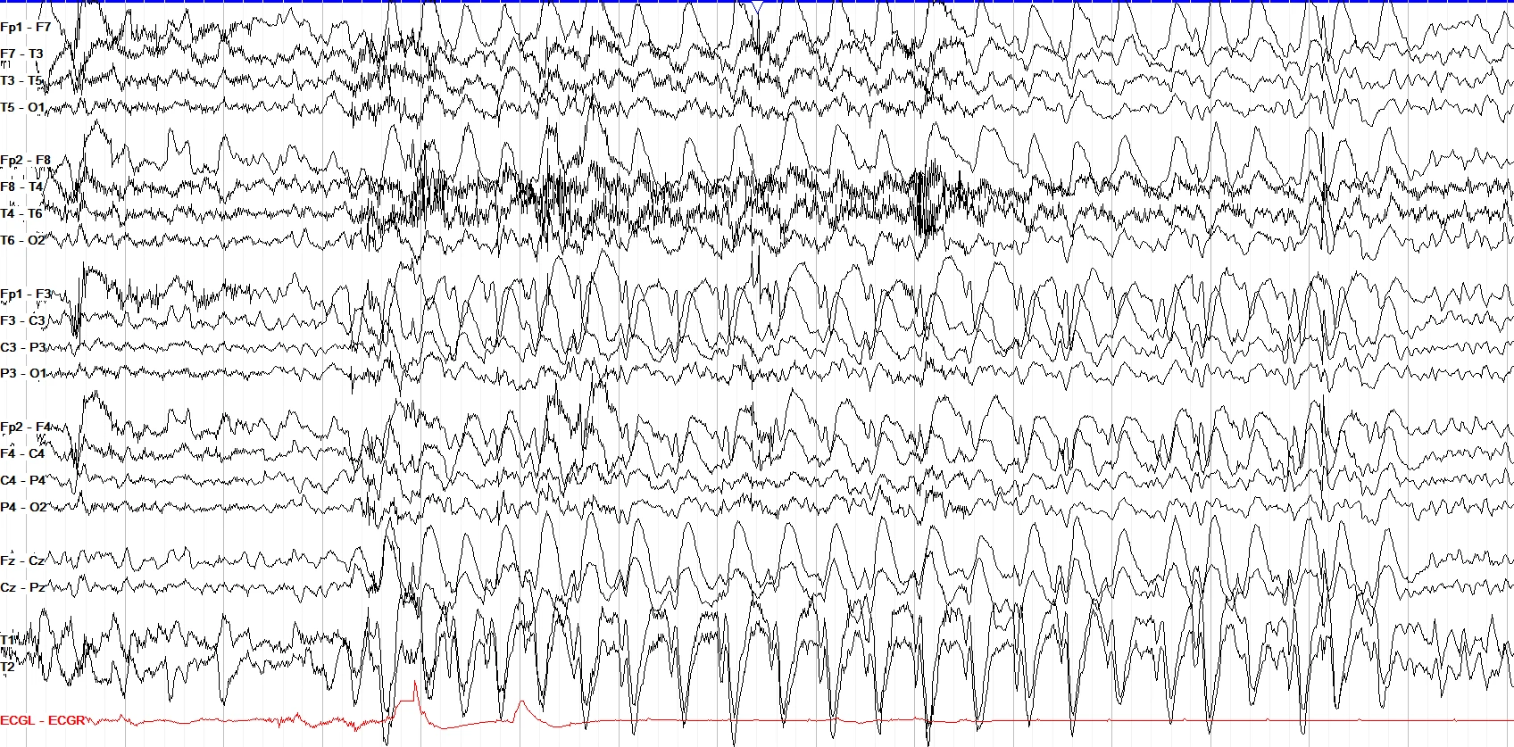 Generalized subclinical seizure EEG OFF
