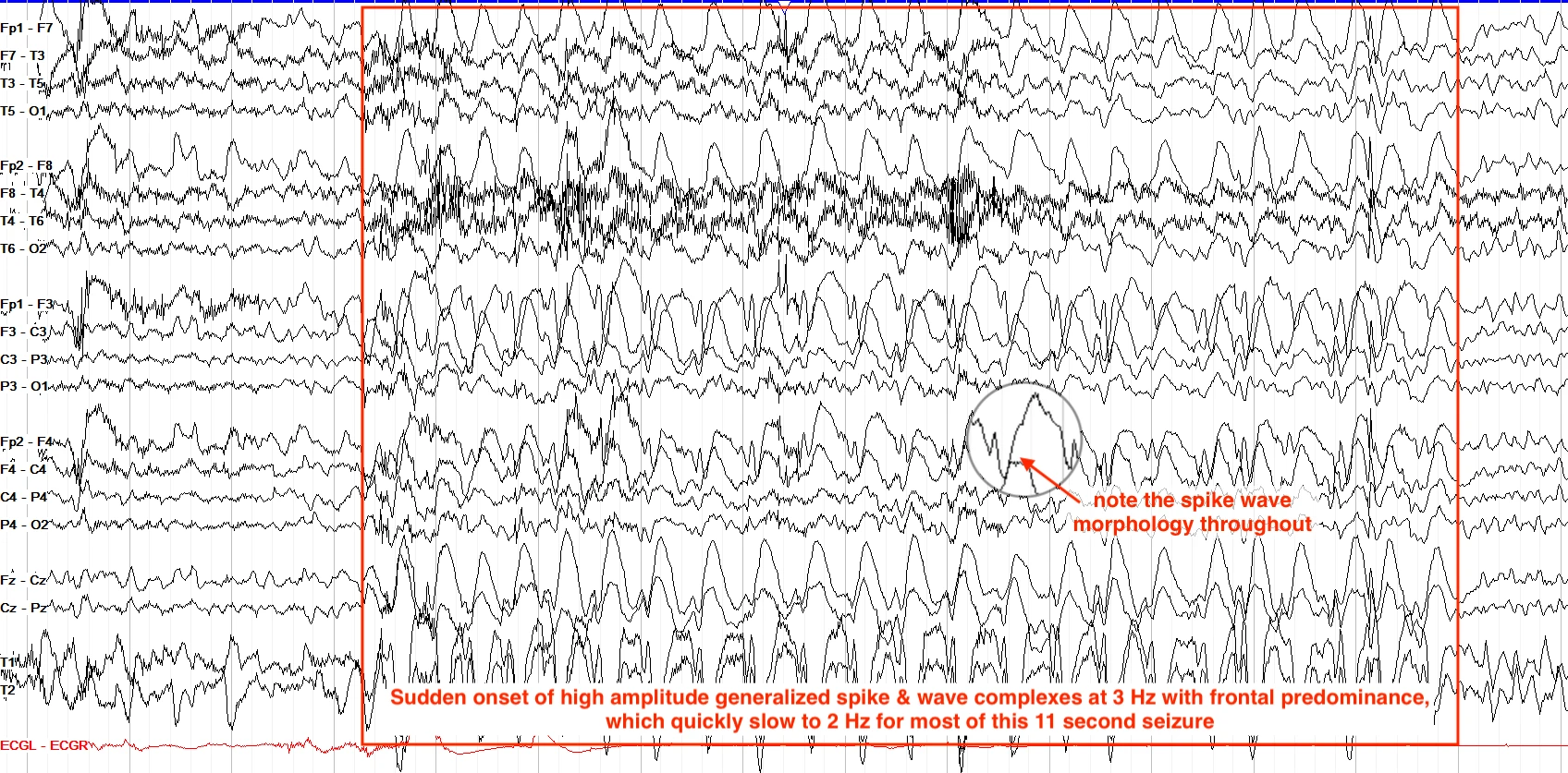 Generalized subclinical seizure EEG ON