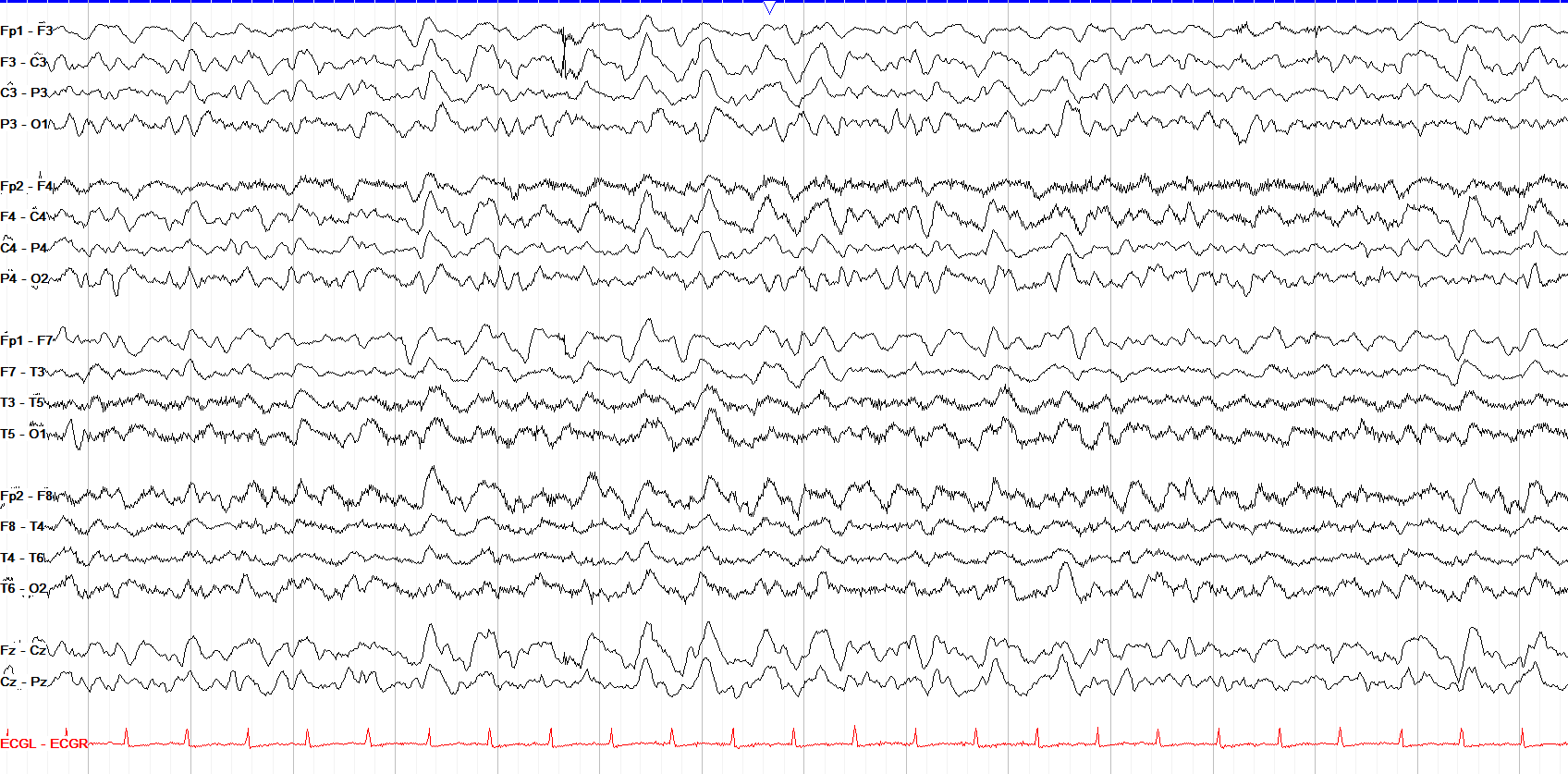 In between GPDs and GRDA EEG OFF