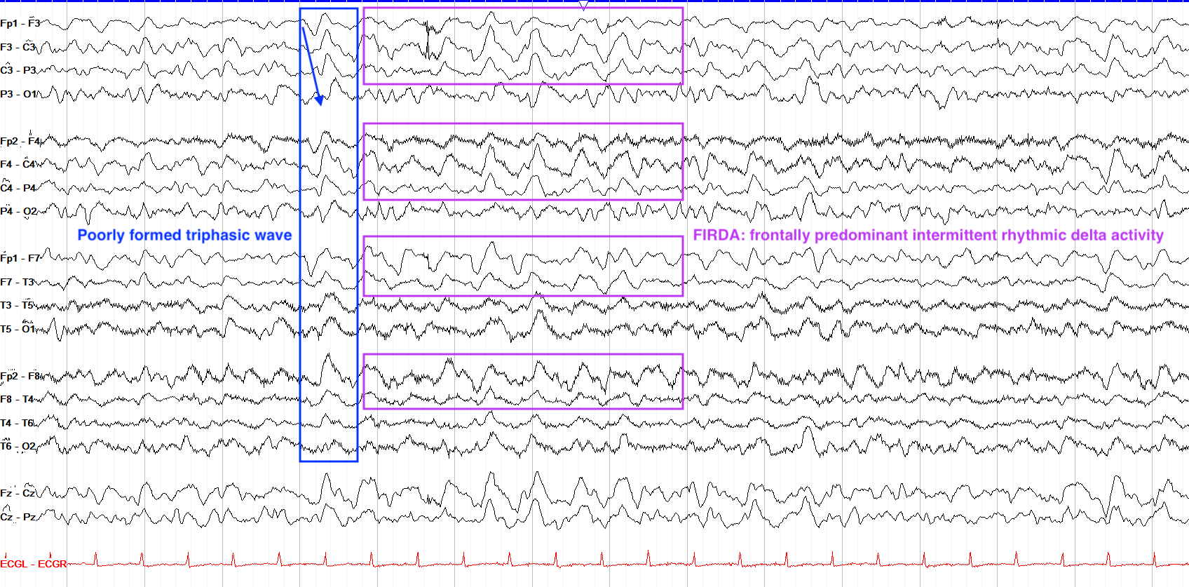 In between GPDs and GRDA EEG ON