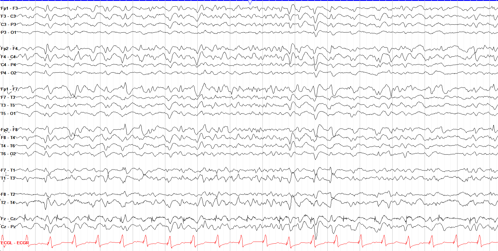 GPDs with triphasic morphology EEG OFF