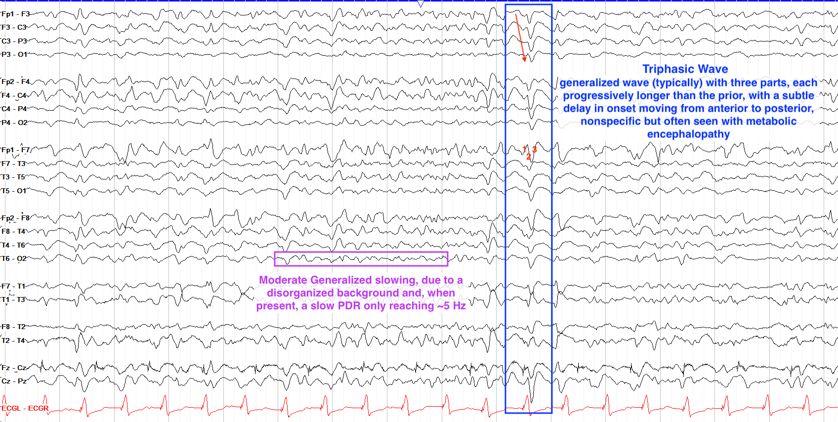 GPDs with triphasic morphology EEG ON