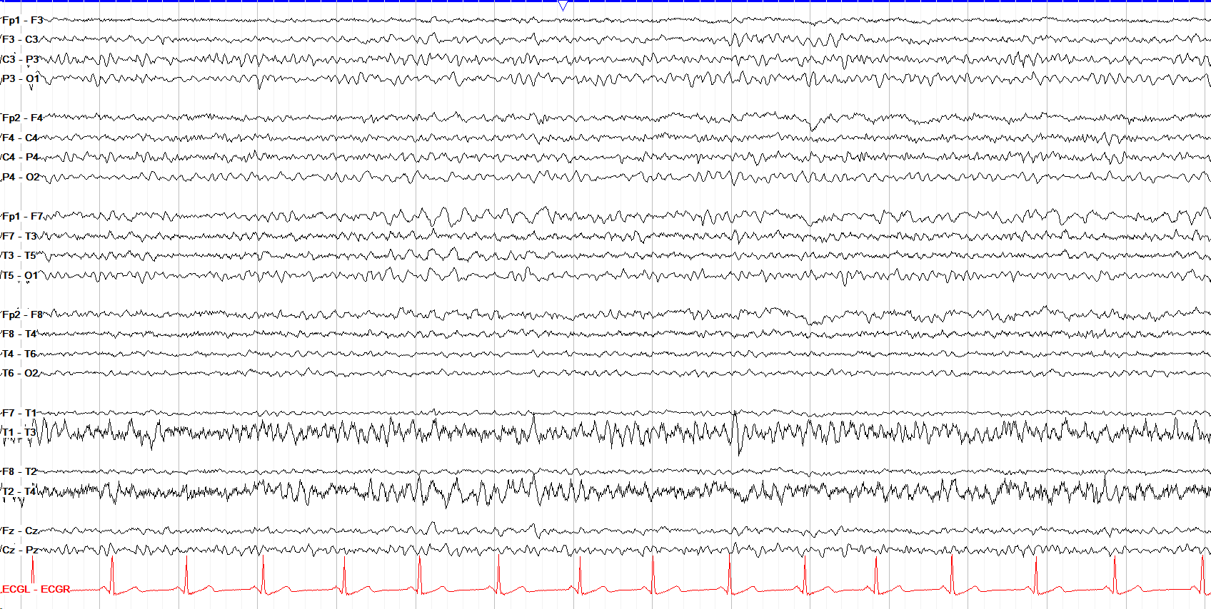 Left temporal intermittent delta slowing EEG without annotation