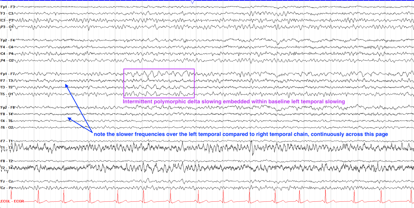 Left temporal intermittent delta slowing EEG annotated