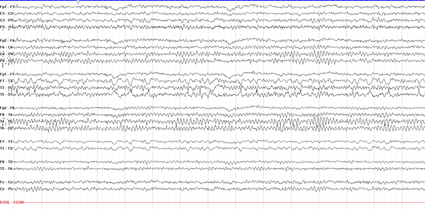 Left continuous polymorphic delta slowing EEG without annotation