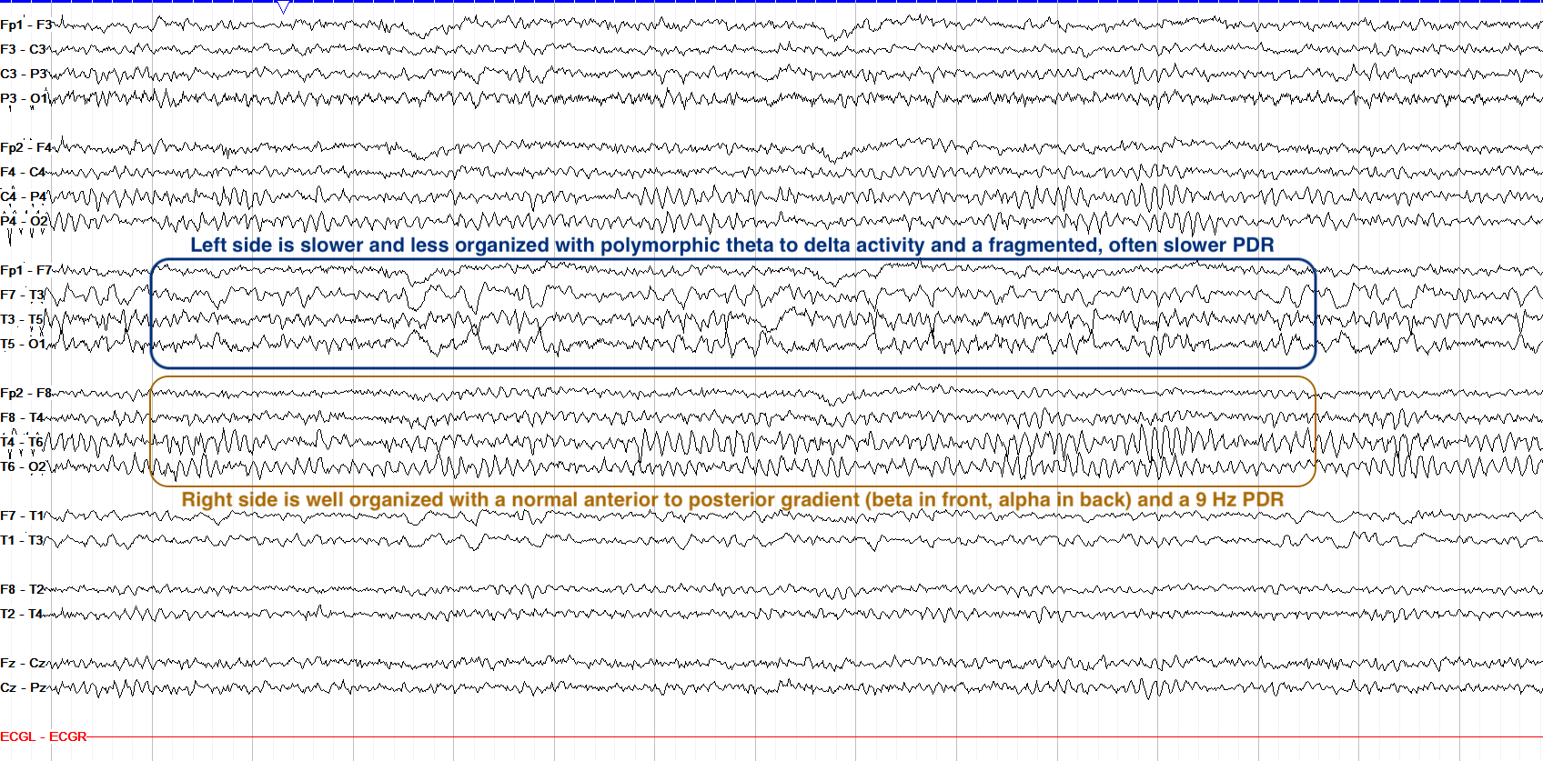 Left continuous polymorphic delta slowing EEG annotated