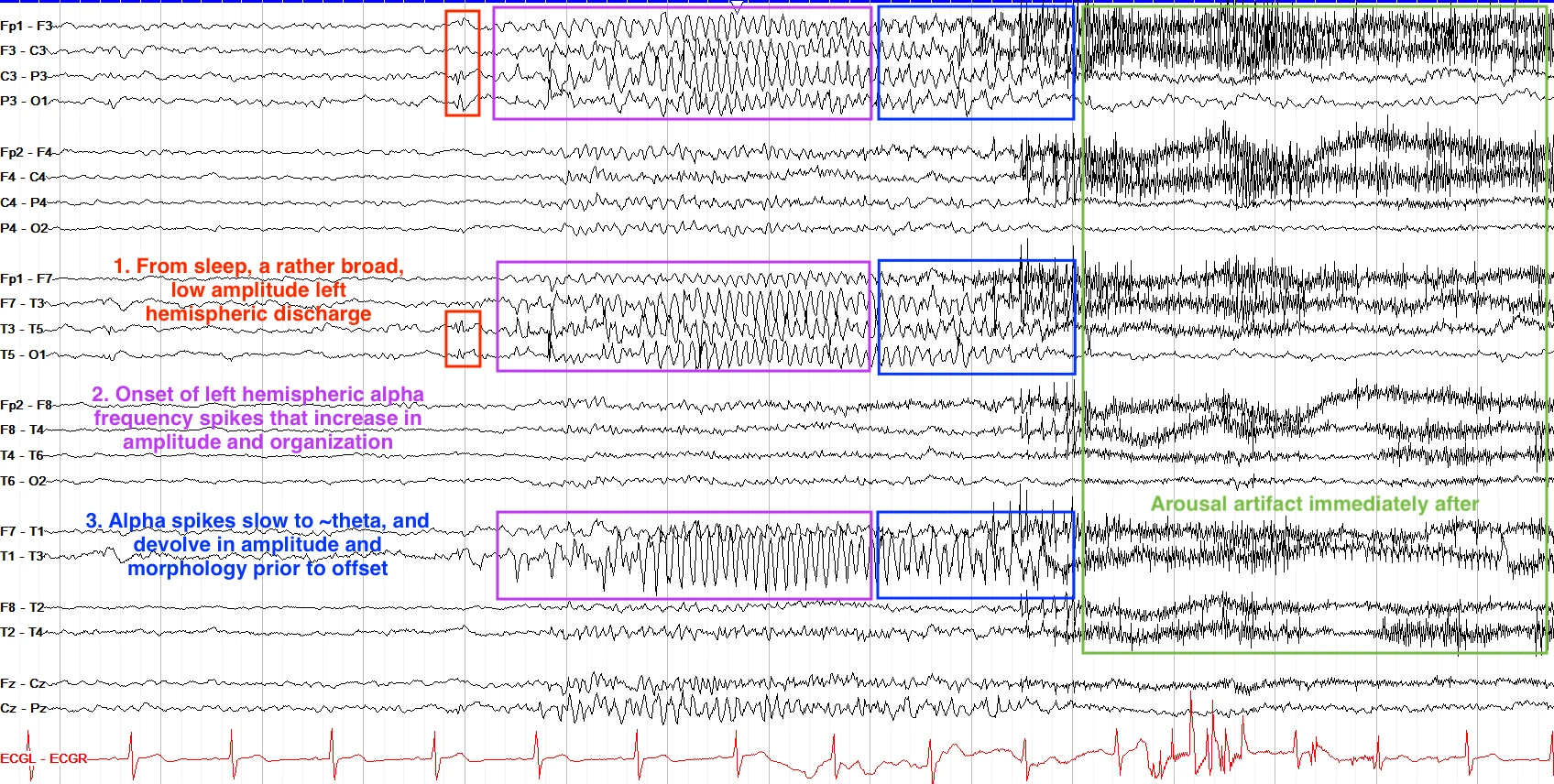 Left hemispheric short focal seizure OFF