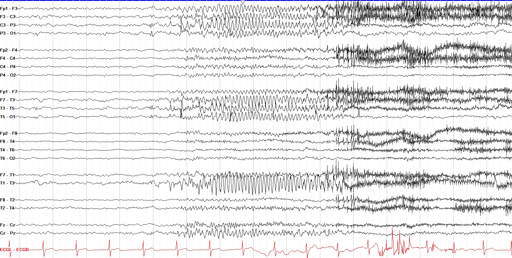 Left hemispheric short focal seizure ON