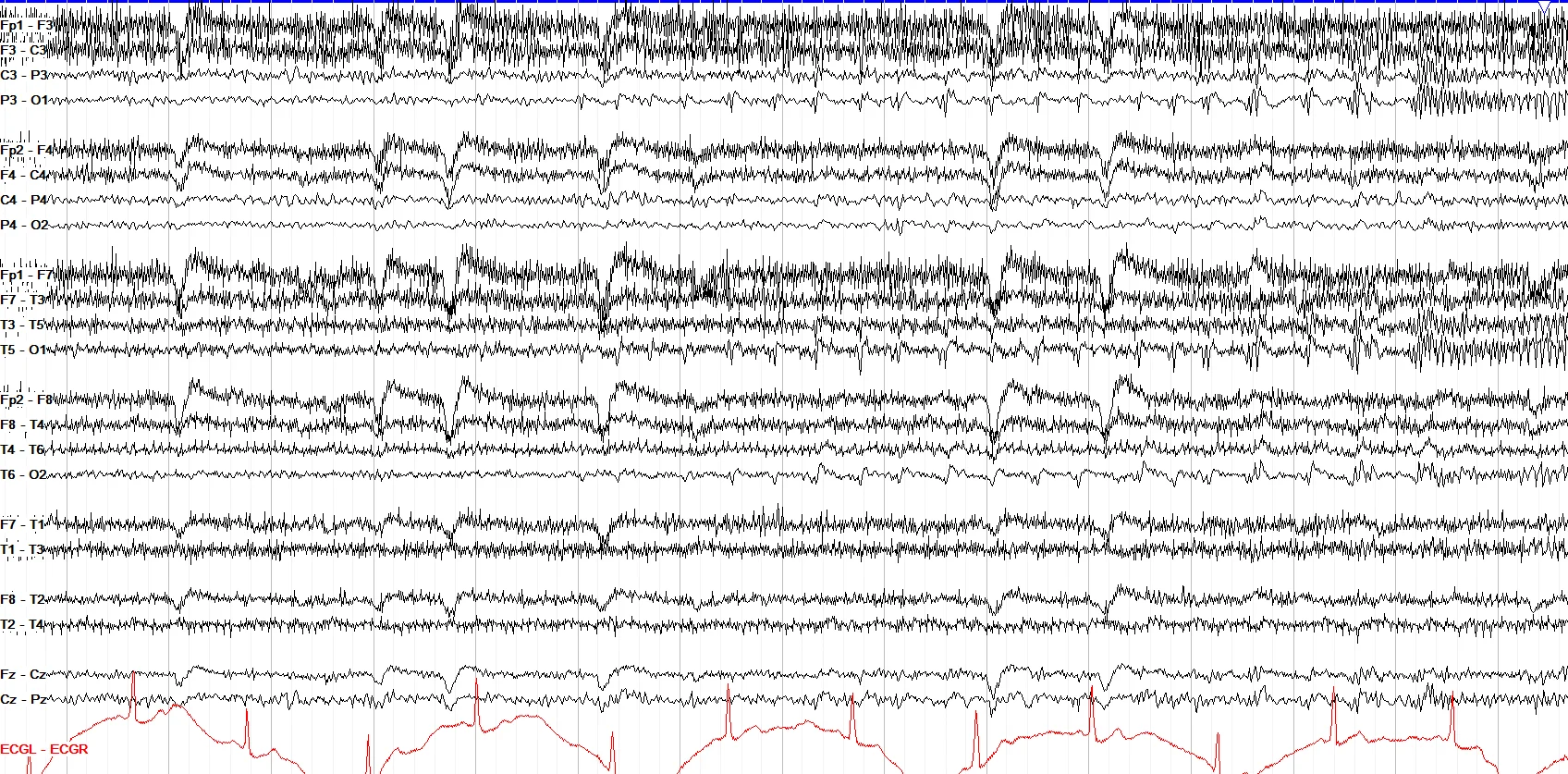 Left occipital seizure OFF