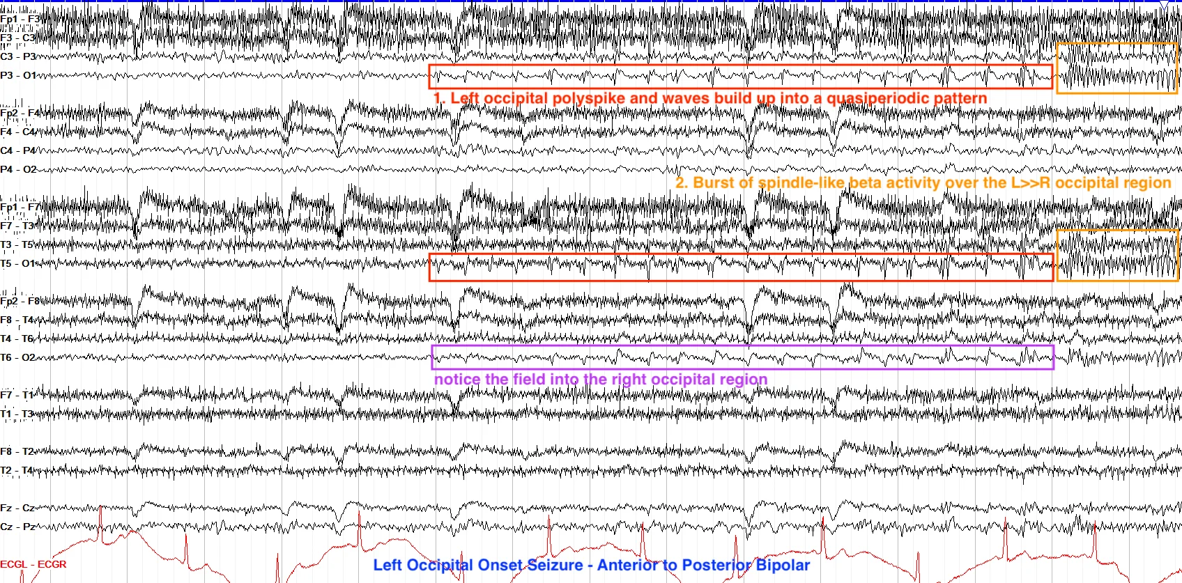 Left occipital seizure ON