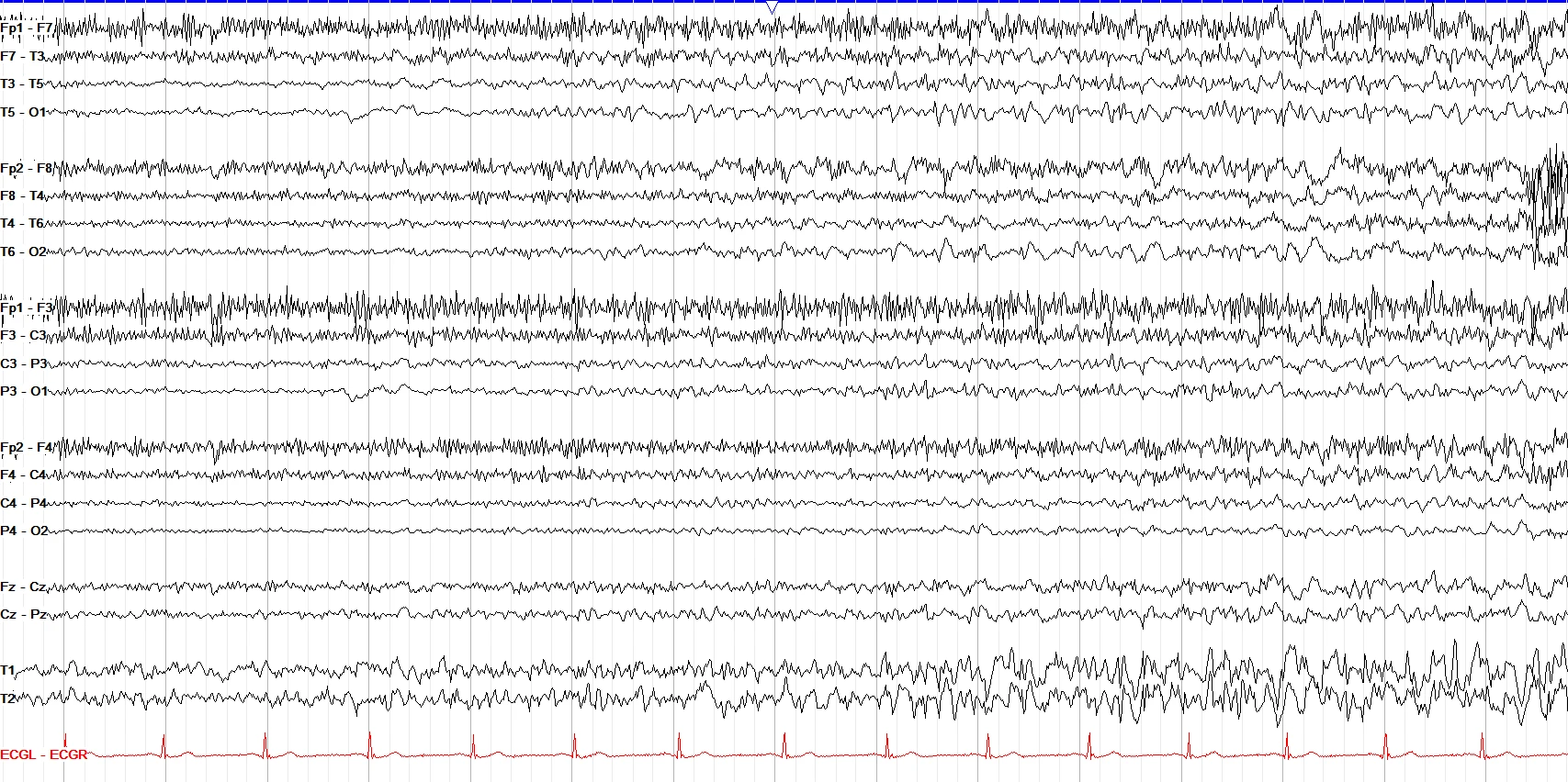 Left posterior quadrant onset seizure OFF