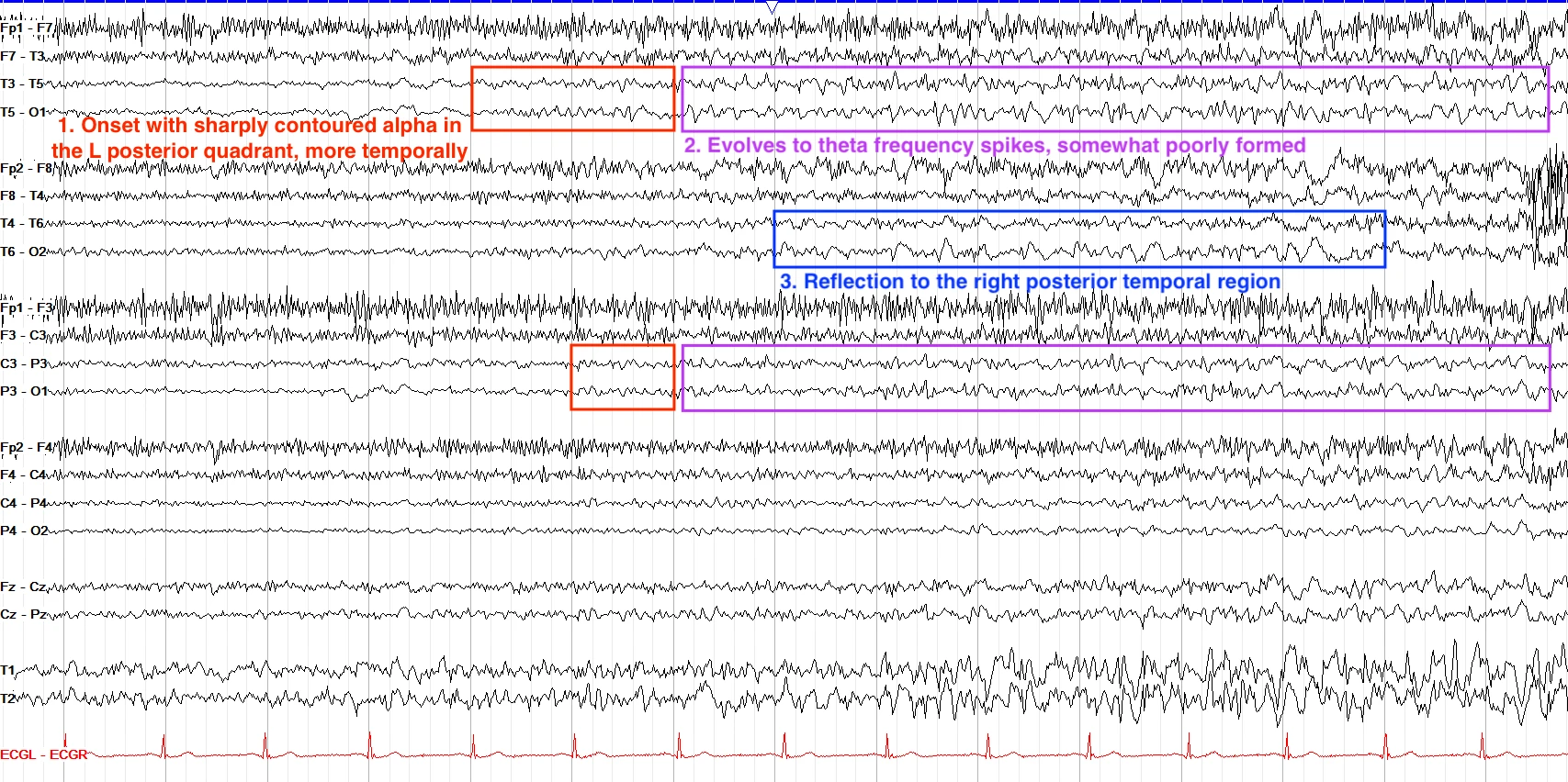 Left posterior quadrant onset seizure ON