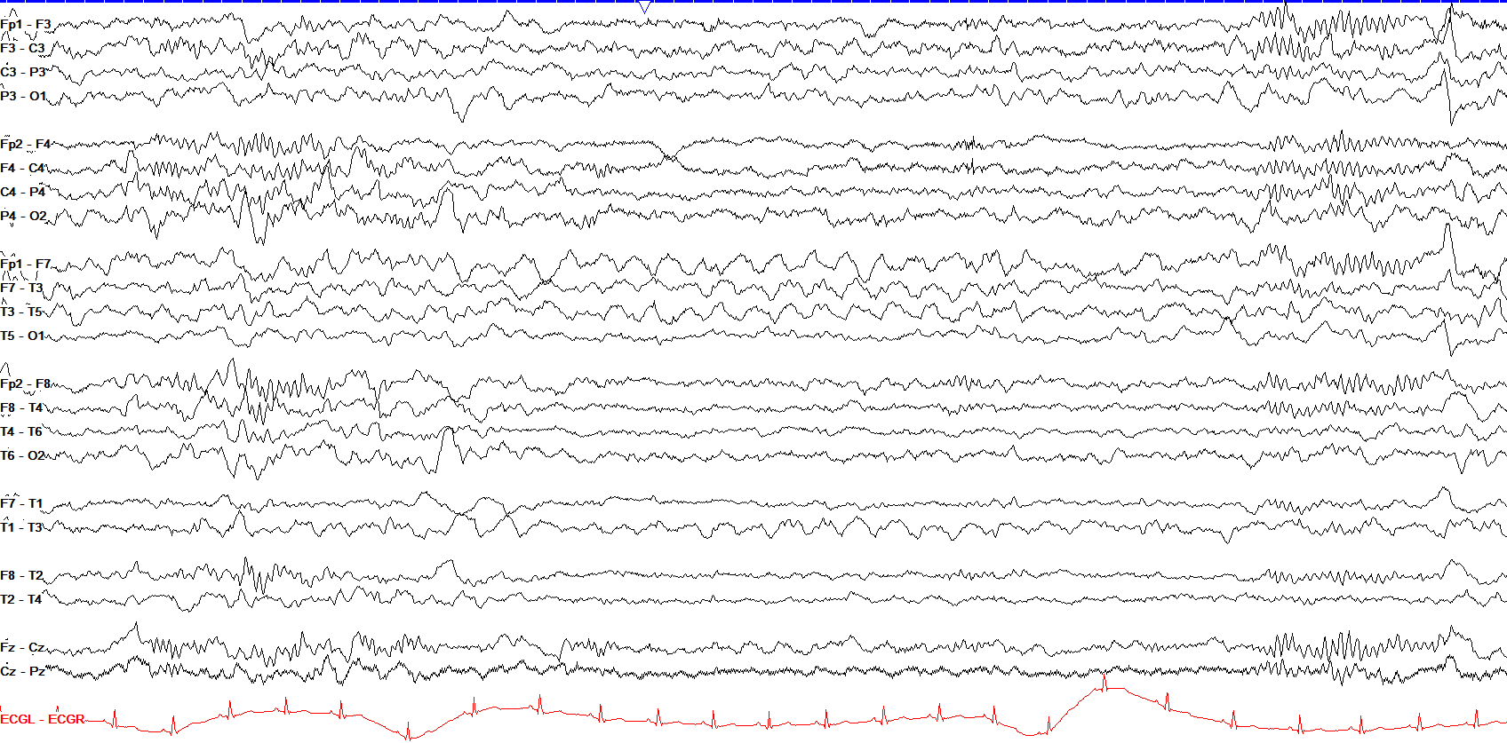 Left temporal LRDA in sleep EEG OFF