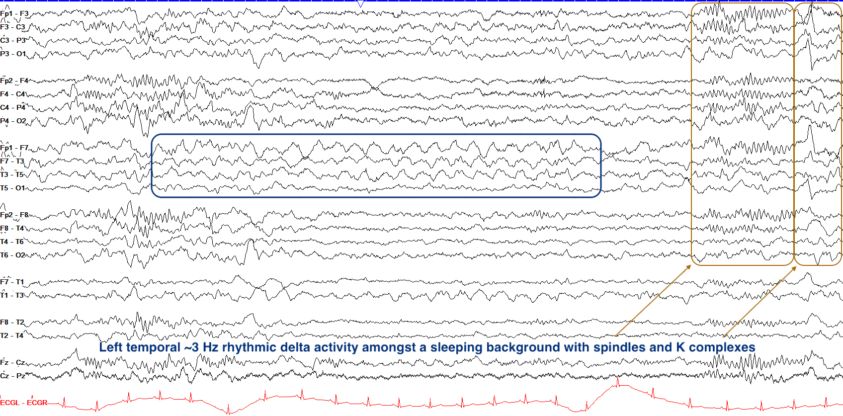 Left temporal LRDA in sleep EEG ON