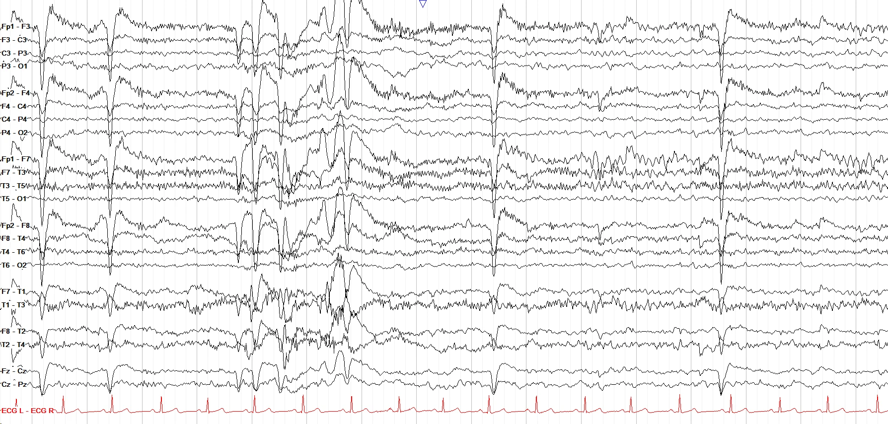 Left temporal focal seizure OFF