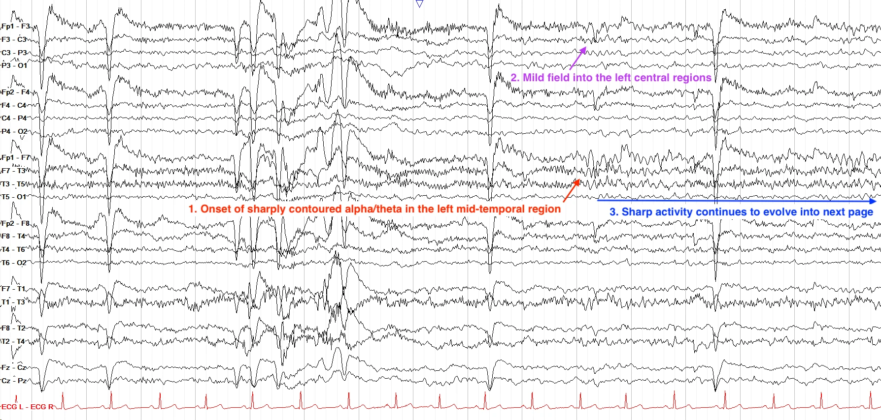 Left temporal focal seizure ON