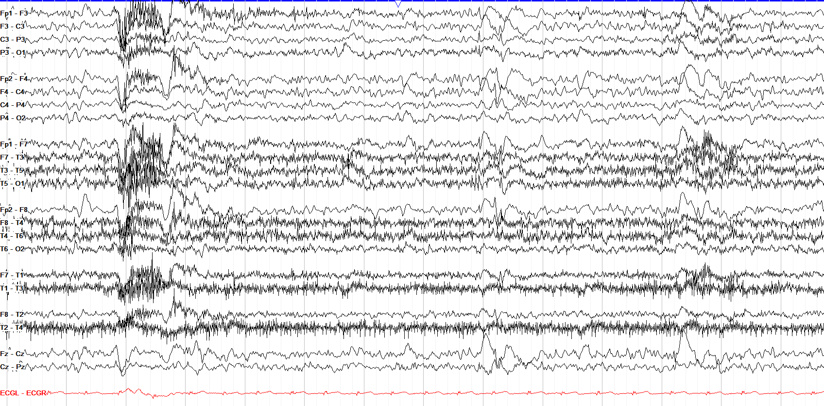 Mild generalized slowing EEG without annotation