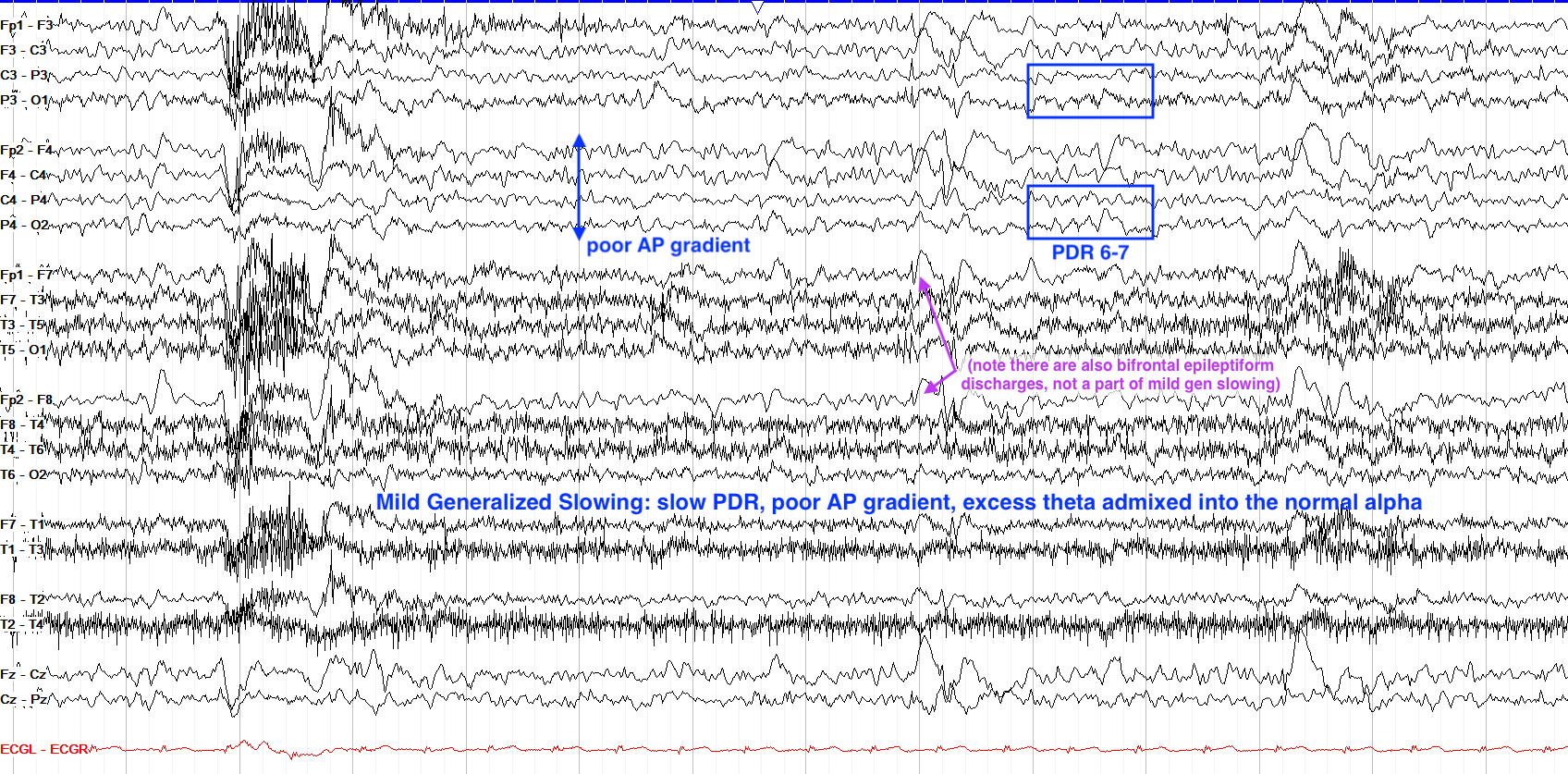 Mild generalized slowing EEG annotated