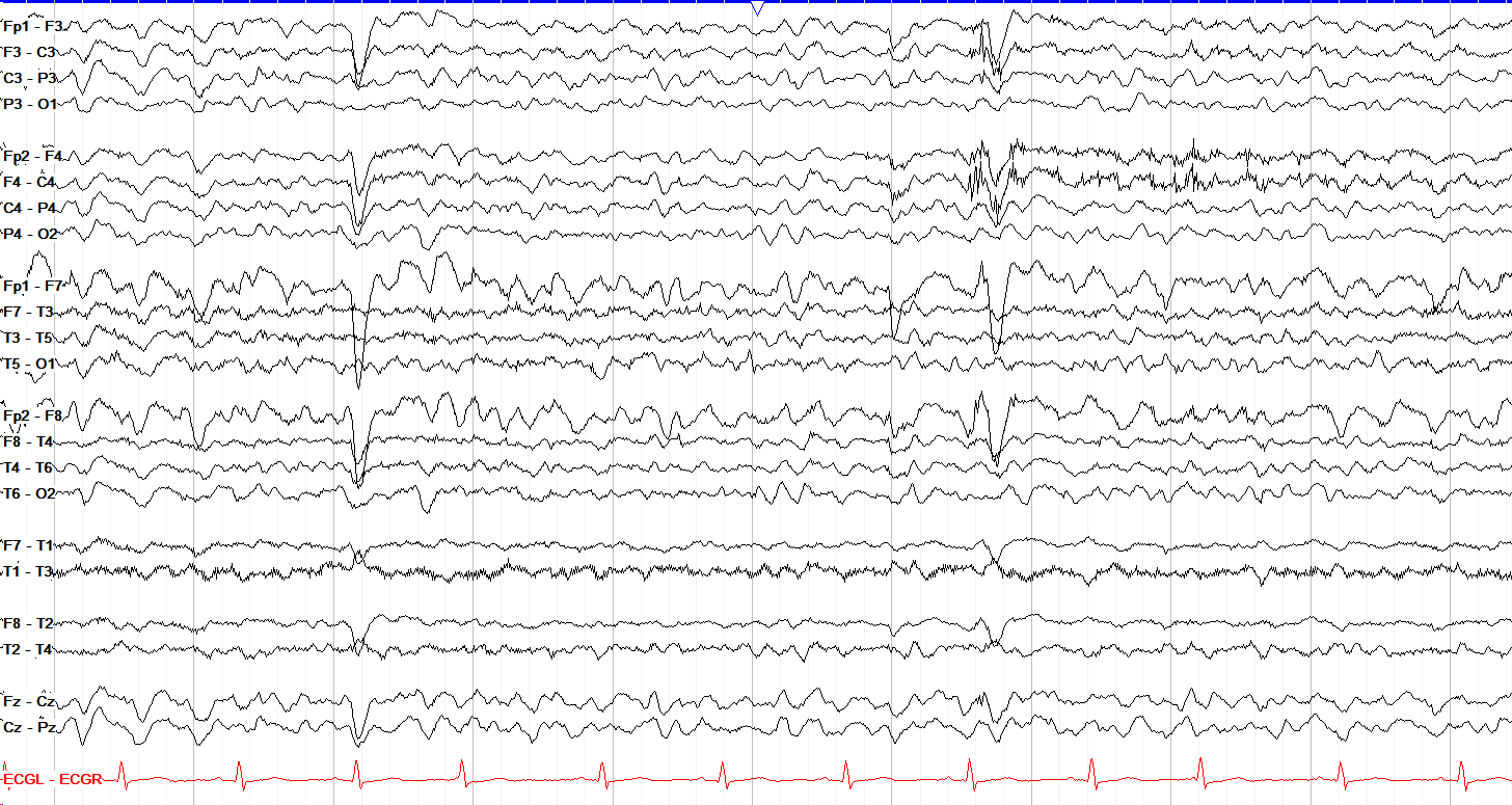 Moderate generalized slowing EEG without annotation